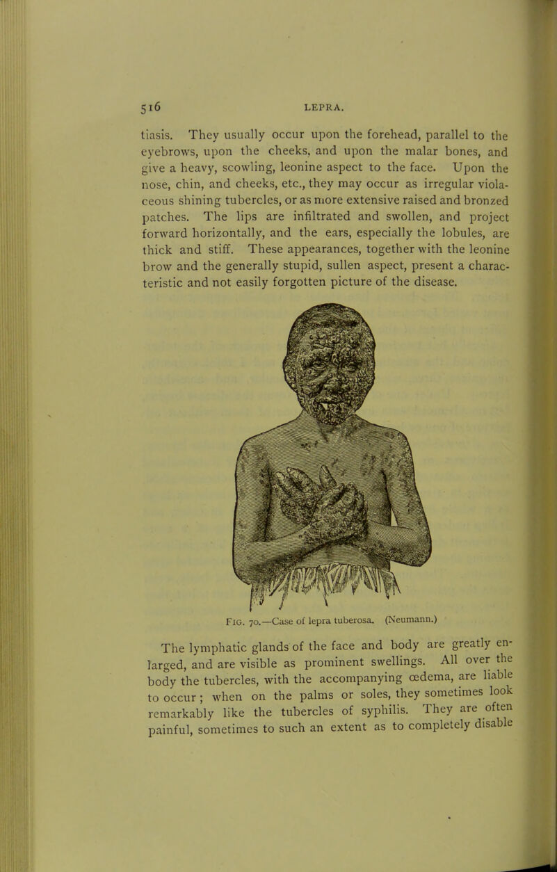 tiasis. They usually occur upon the forehead, parallel to the eyebrows, upon the cheeks, and upon the malar bones, and give a heavy, scowling, leonine aspect to the face. Upon the nose, chin, and cheeks, etc., they may occur as irregular viola- ceous shining tubercles, or as more extensive raised and bronzed patches. The lips are infiltrated and swollen, and project forward horizontally, and the ears, especially the lobules, are thick and stiff. These appearances, together with the leonine brow and the generally stupid, sullen aspect, present a charac- teristic and not easily forgotten picture of the disease. V Fig. 70.—Case of lepra tuberosa. (Neumann.) The lymphatic glands of the face and body are greatly en- larged, and are visible as prominent swellings. All over the body the tubercles, with the accompanying oedema, are liable to occur ; when on the palms or soles, they sometimes look remarkably like the tubercles of syphilis. They are often painful, sometimes to such an extent as to completely disable