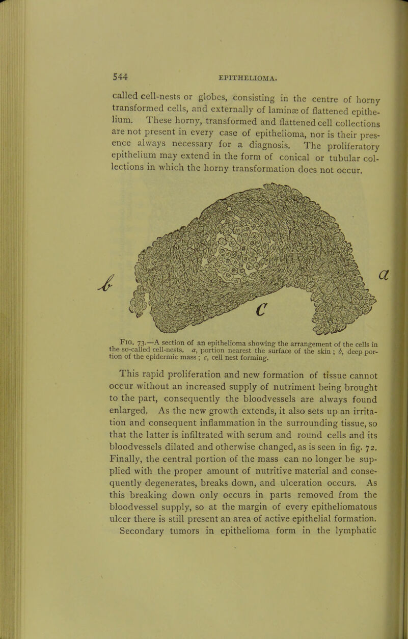 called cell-nests or globes, consisting in the centre of horny transformed cells, and externally of laminae of flattened epithe- lium. These horny, transformed and flattened cell collections are not present in every case of epithelioma, nor is their pres- ence always necessary for a diagnosis. The proliferatory epithelium may extend in the form of conical or tubular col- lections in which the horny transformation does not occur. Fig. 73.—A section of an epithelioma showing- the arrangement of the cells in the so-called cell-nests, a, portion nearest the surface of the skin ; b, deep por- tion of the epidermic mass ; c, cell nest forming. This rapid proliferation and new formation of tissue cannot occur without an increased supply of nutriment being brought to the part, consequently the bloodvessels are always found enlarged. As the new growth extends, it also sets up an irrita- tion and consequent inflammation in the surrounding tissue, so that the latter is infiltrated with serum and round cells and its bloodvessels dilated and otherwise changed, as is seen in fig. 72. Finally, the central portion of the mass can no longer be sup- plied with the proper amount of nutritive material and conse- quently degenerates, breaks down, and ulceration occurs. As this breaking down only occurs in parts removed from the bloodvessel supply, so at the margin of every epitheliomatous ulcer there is still present an area of active epithelial formation. Secondary tumors in epithelioma form in the lymphatic