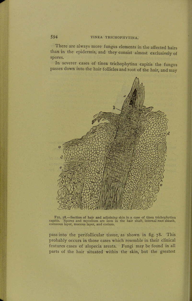 There are always more fungus elements in the affected hairs than in the epidermis, and they consist almost exclusively of spores. In severer cases of tinea trichophytina capitis the fungus passes down into the hair follicles and root of the hair, and may Fig. 78.—Section of hair and adjoining skin in a case of tinea trichophytina capitis. Spores and mycelium are seen in the hair shaft, internal root sheath, corneous layer, mucous layer, and corium. pass into the perifollicular tissue, as shown in fig. 78. This probably occurs in those cases which resemble in their clinical features cases of alopecia areata. Fungi may be found in all parts of the hair situated within the skin, but the greatest