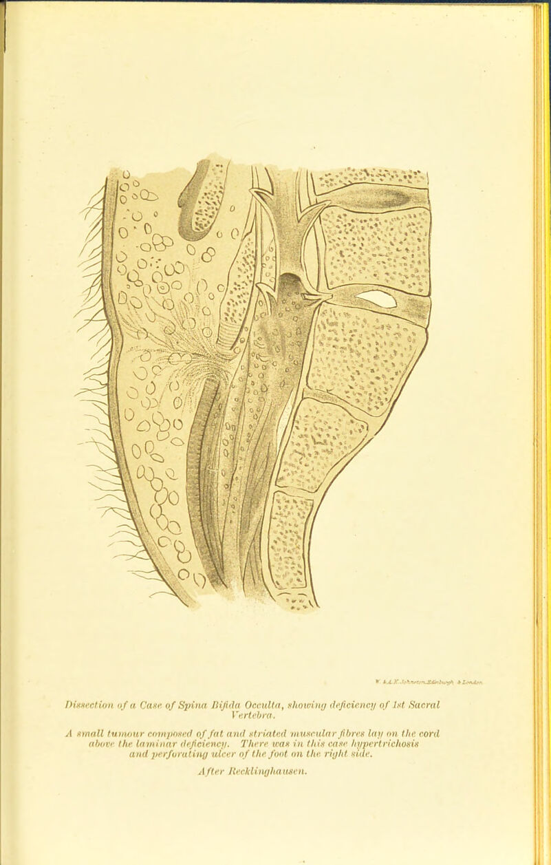 nixnecl ion uf a Cane, of Spina liifida Occulta , shoioinij deficiency of lut Sacral I'ertebra. A umall tumour cmnpnued of fat ami utrintcd muxnilrir fihreK Uni on the cord above the laminar defidencji. There wax in this cane hypertrichosis and iierfuratiny ulcer of the font nn the riijht xide. After Hecklinghauscn.