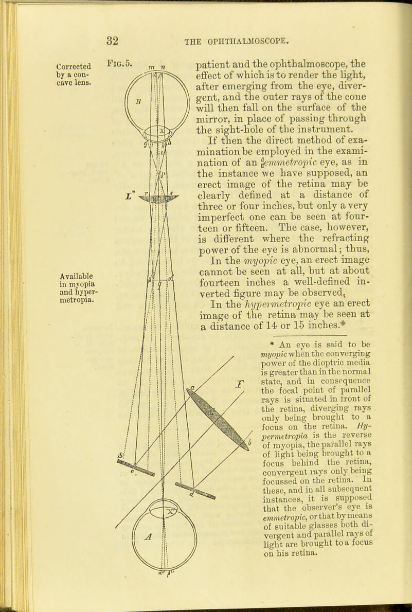 Corrected FlG.5. by a eon- cave lens. Available in myopia and hyper- metropia. patient and the ophthalmoscope, the effect of which is to render the light, after emerging from the eye, diver- gent, and the outer rays of the cone will then fall on the surface of the mirror, in place of passing through the sight-hole of the instrument. If then the direct method of exa- mination be employed in the exami- nation of an lammetro'pic eye, as in the instance we have supposed, an erect image of the retina may be clearly defined at a distance of three or four inches, but only a very imperfect one can be seen at four- teen or fifteen. The case, however, is diff'erent where the refracting power of the eye is abnormal; thus. In the myopic eye, an erect image cannot be seen at all, but at about fourteen inches a well-defined in- verted figure may be observed. In the hypermetropic eye an erect image of the retina may be seen at a distance of 14 or 15 inches.* * An eye is said to be mtjopicwhen the converging power of the dioptric media is greater than in the normal state, and in consequence the focal point of pai-allel rays is situated in tront of the retina, diverging rays only being brought to a focus on the retina. Hy- permttropia is the reverse of myopia, the parallel rays of light being brought to a focus behind the retina, convergent rays only being focussed on the retina. In these, and in all subsequent instances, it is supposed that the observer's eye is evimetrojnc, or that by means of suitable glasses both di- vergent and parallel rays of light are brought to a focus on his retina.