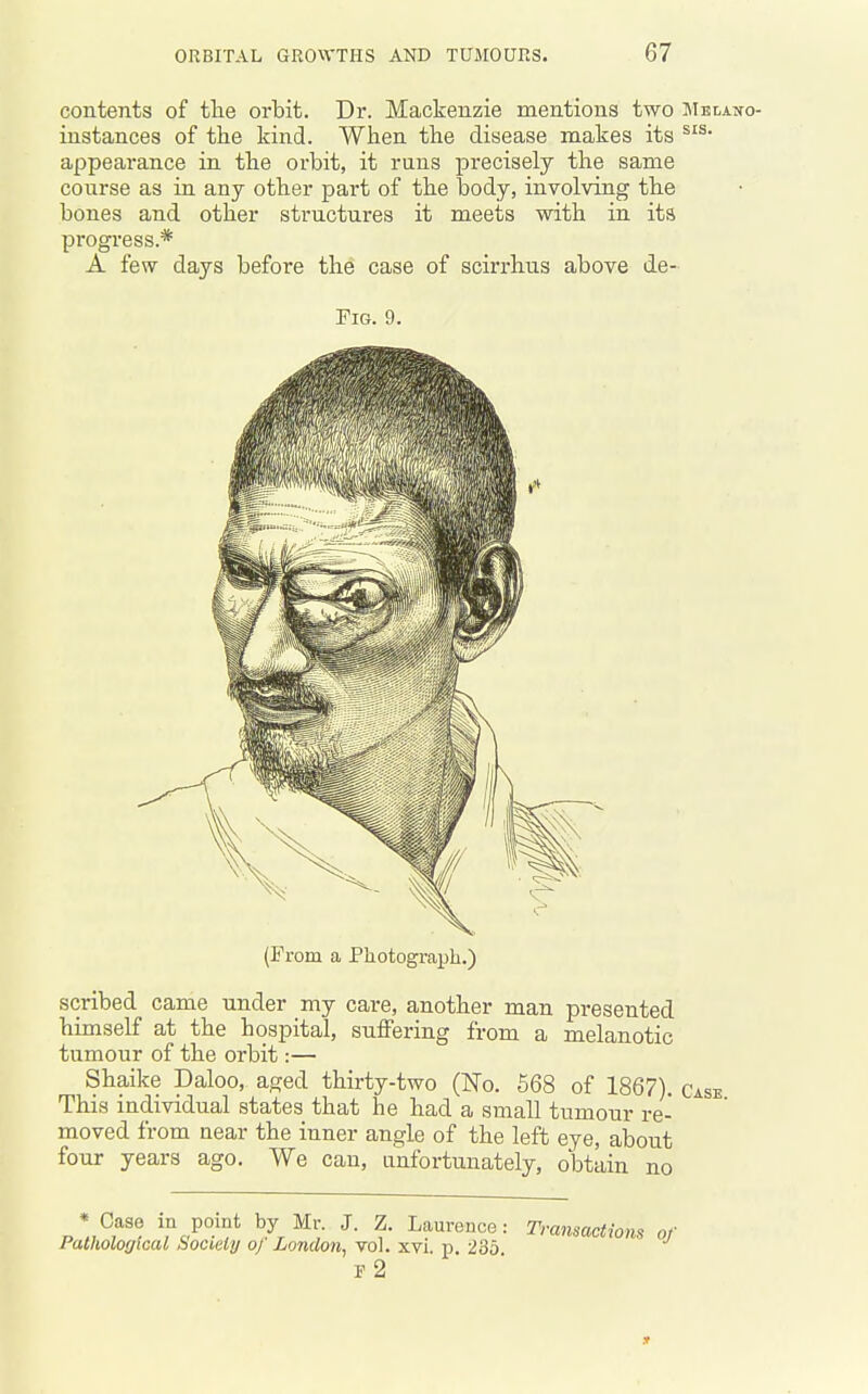 contents of tlie orbit. Dr. Mackenzie mentions two Mblano- instances of the kind. When the disease makes its appearance in the orbit, it runs precisely the same conrse as in any other part of the body, involving the bones and other structures it meets with in its progress.* A few days before the case of scirrhus above de- FiG. 9. (rrom a Photograph.) scribed came under my care, another man presented himself at the hospital, suflFering from a melanotic tumour of the orbit:— Shaike Daloo, aged thirty-two (No. 568 of 1867). This individual states that he had a small tumour re- moved from near the inner angle of the left eye, about four years ago. We can, unfortunately, obtain no * Case in point by Mr. J. Z. Laurence: Transactions of Pathological Society oj London^ vol. xvi. p, 235 s 2