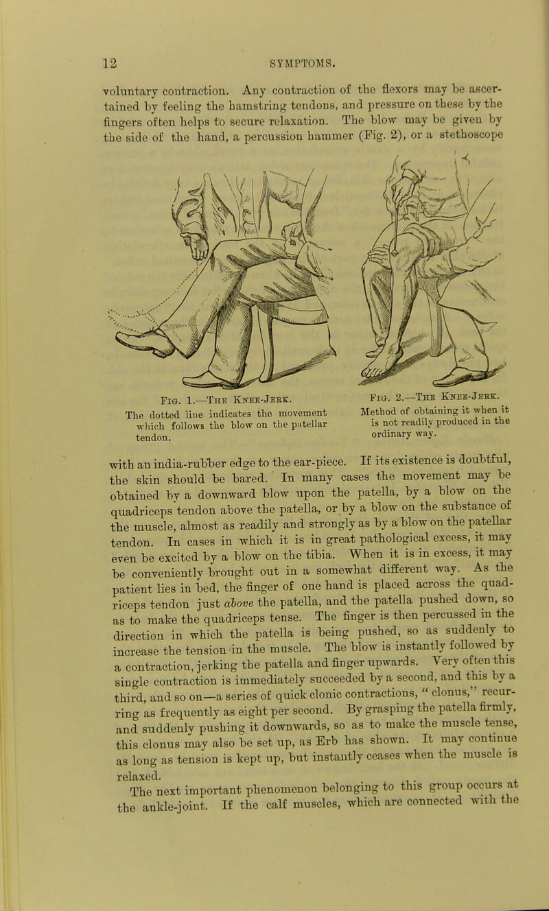 voluntary contraction. Any contraction of the flexors may he ascer- tained by feeling the hamstring tendons, and pressure on these by the fingers often helps to secure relaxation. The blow may be given by the side of the hand, a percussion hammer (Fig. 2), or a stethoscope Fig. 1.—The Knee-Jeek. The dotted line indicates the movement which follows the blow on the patellar tendon. Fig. 2.—The Knee-Jeek. Method of obtaining it when it is not readily produced in the ordinary way. with an india-rubber edge to the ear-piece. If its existence is doubtful, the skin should be bared. In many cases the movement may be obtained by a downward blow upon the patella, by a blow on the quadriceps'tendon above the patella, or by a blow on the substance of the muscle, almost as readily and strongly as by a blow on the pateUar tendon. In cases in which it is in great pathological excess, it may even be excited by a blow on the tibia. When it is in excess, it may be conveniently brought out in a somewhat different way. As the patient lies in bed, the finger of one hand is placed across the quad- riceps tendon just above the patella, and the patella pushed down, so as to make the quadriceps tense. The finger is then percussed m the direction in which the patella is being pushed, so as suddenly to increase the tension in the muscle. The blow is instantly followed by a contraction, jerking the patella and finger upwards. Very often this single contraction is immediately succeeded by a second, and this by a third, and so on—a series of quick clonic contractions,  clonus, recur- ring as frequently as eight per second. By grasping the patella firmly, and suddenly pushing it downwards, so as to make the muscle tense, this clonus may also be set up, as Erb has shown. It may continue as long as tension is kept up, but instantly ceases when the muscle is relaxed. . The next important phenomenon belonging to this group occurs at the ankle-joint. If the calf muscles, which are connected with the