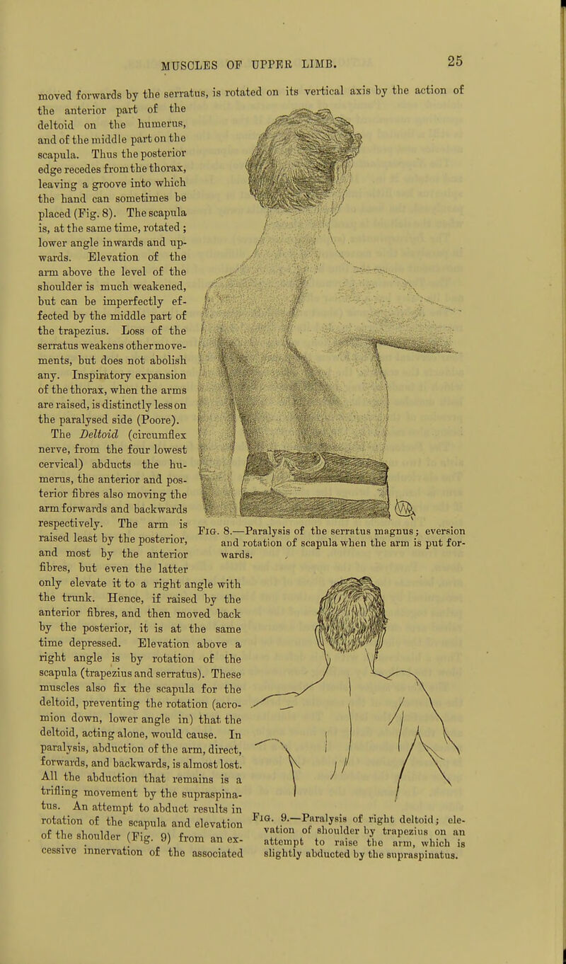 / moved forwards by the serratus, is rotated on its veiiical axis by the action of the anterior part of the deltoid on the humerus, and of the middle part on the scapula. Thus the posterior edge recedes from the thorax, leaving a groove into which the hand can sometimes be placed (Pig. 8). The scapula is, at the same time, rotated ; lower angle inwards and up- wards. Elevation of the ann above the level of the shoulder is much weakened, but can be imperfectly ef- | fected by the middle part of the trapezius. Loss of the | serratus weakens othermove- | ments, but does not abolish i any. Inspiratory expansion of the thorax, when the arms are raised, is distinctly less on | the paralysed side (Poore). | The Deltoid (circumflex |'' nerve, from the four lowest |? cervical) abducts the hu- |i merus, the anterior and pos- terior fibres also moving the arm forwards and backwards respectively. The arm is raised least by the posterior, and most by the anterior fibres, but even the latter only elevate it to a right angle with the trunk. Hence, if raised by the anterior fibres, and then moved back by the posterior, it is at the same time depressed. Elevation above a right angle is by rotation of the scapula (trapezius and serratus). These muscles also fix the scapula for the deltoid, preventing the rotation (acro- mion down, lower angle in) that the deltoid, acting alone, would cause. In paralysis, abduction of the arm, direct, forwards, and backwards, is almost lost. All the abduction that remains is a trifling movement by the supraspina- tus. An attempt to abduct results in rotation of the scapula and elevation ^^S- 9—P«>'fy7 of ght deltoid; ele- of thfi sbmiUor a\ e vation of shoulder by trapezius on an ot the shoulder (P,g. 9) from an ex- attempt to raise tl.e arm, which is cessive innervation of the associated slightly abducted by the supraspinatus. 1; Fig. 8.—Paralysis of the serratus magnus; eversion and rotation of scapula when the arm is put for- wards.