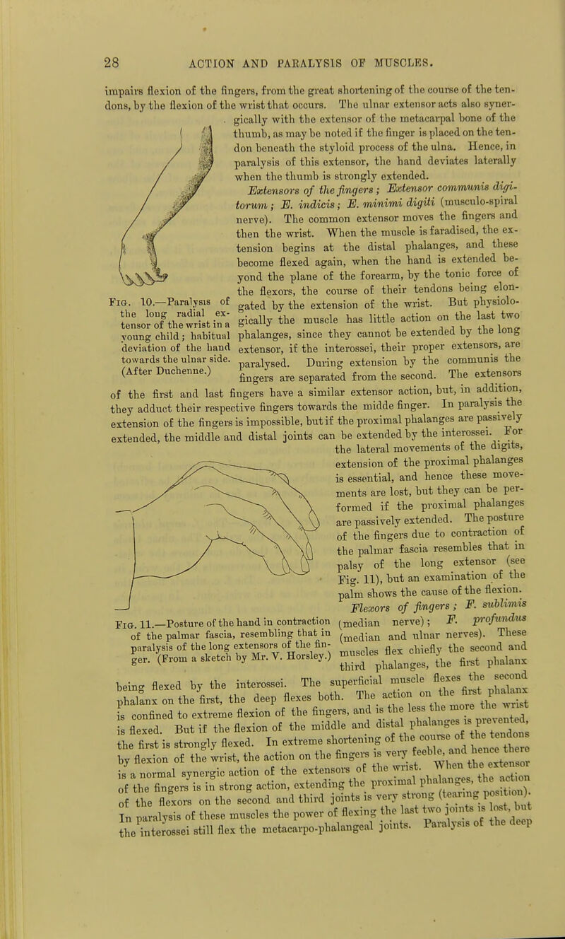 Fig. 10.—Paralysis of the loug radial ex- tensor of the wrist in a impairs flexion of the fingers, from the great shoi-teningof the course of the ten- dons, by the flexion of the wrist that occurs. The ulnar extensor acts also sj'ner- gically with the extensor of the metacarpal bone of the thumb, as may be noted if tlie finger is placed on the ten- don beneath the styloid process of the ulna. Hence, in paralysis of this extensor, the hand deviates laterally when the thumb is strongly extended. Extensors of the fingers ; Extensor comrrmnis diffi- torum; E. indicis; E. minimi digiti (museulo-spiral nerve). The common extensor moves the fingere and then the wrist. When the muscle is faradised, the ex- tension begins at the distal phalanges, and these become flexed again, when the hand is extended be- yond the plane of the forearm, by the tonic force of the flexors, the course of their tendons being elon- gated by the extension of the wrist. But physiolo- tensorottnewris.ma gically the muscle has 1^*^'^^° T^^' IIp W young child; habitual phalanges, since they cannot be extended by the long deviation of the band extensor, if the interossei, their proper extensore, are towards the ulnar side, paralysed. During extension by the communis the (After Duchenne.) ^^^^^.^ separated from the second. The extensors of the first and last fingers have a similar extensor action, but, in addition, they adduct their respective fingers towards the midde finger. In paralysis the extension of the fingers is impossible, but if the proximal phalanges are passively extended, the middle and distal joints can be extended by the interossei. For the lateral movements of the digits, extension of the proximal phalanges is essential, and hence these move- ments are lost, but they can be per- formed if the proximal phalanges are passively extended. The posture of the fingers due to contraction of the palmar fascia resembles that m palsy of the long extensor (see Fig. 11), but an examination of the palm shows the cause of the flexion. Flexors of fingers; F. suUimis (median nerve); F. profundus - - ' These Fi&. 11.—Posture of the hand in contraction of the palmar fascia, resembling that in /^^g^^^n and ulnar nerves) paralysis of the long extensors of the fin- , n chieflv the second and ler.W--l.etch by Mr. V.Horsley.) -^^^^^2:^^ fi,,t phalanx beinc^ flexed by the interossei. The superficial muscle flexes the second phTknx on the first, the deep flexes both. The action on the P -knx fs confined to extreme flexion of the fingers, and is the less the more the w st flexed. But if the flexion of the middle and distal phalanges is prevented he first is strongly flexed. In extreme shortening of --e of ^^^^^^^^^^^^^ by flexion of the wrist, the action on the fingei-s is veiy f is a normal synergic action of the extensoi-s of the wnst. ^J^^ f f^^^^^^^ of the fingers is in strong action, extending the proximal pha anges, the action the fle'ors on the seLd and third joints is very strong ^^^^^^^^^^^^^l^^ In paralysis of these muscles the power of flexing ho ast two joints is bst, but the interossei still flex the metacarpcphalangeal joints. Paralysis of the deep