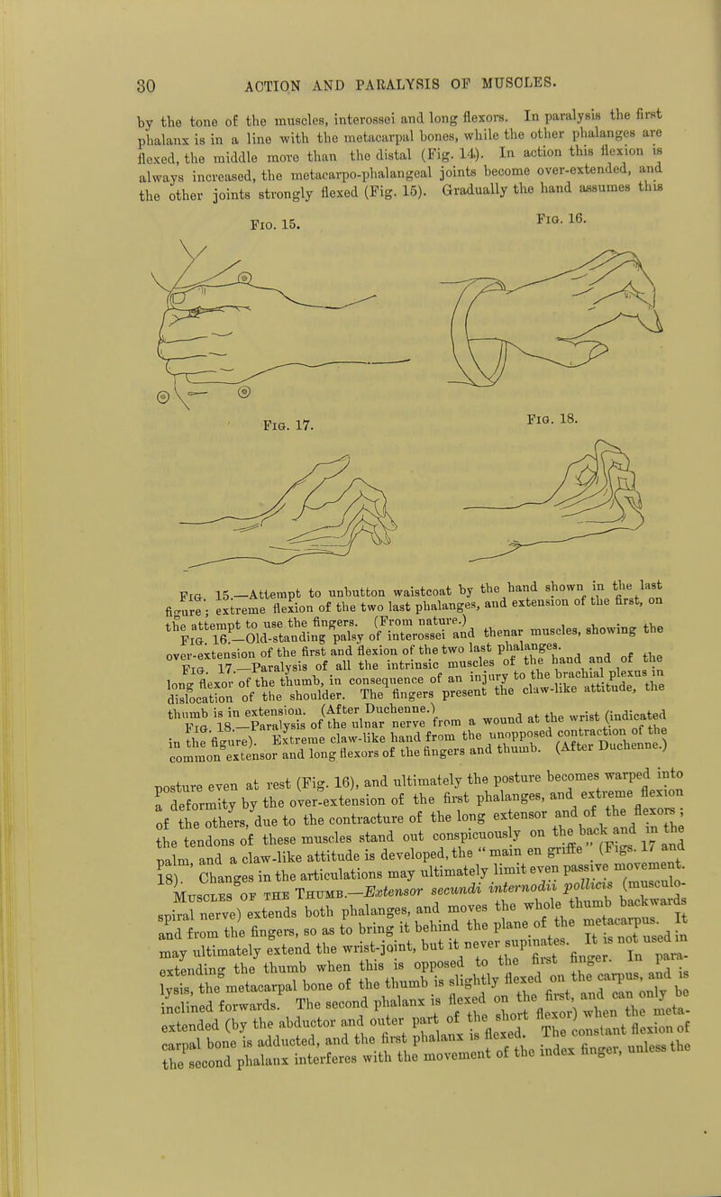 by tlie tone the muscles, interossei and long flexors. In paralysis the first phalanx is in a line Avith the metacarpal bones, while the other phalanges are flexed, the middle more than the distal (Fig. 14). In action this flexion m always increased, the metacarpo-phalangeal joints become over-extended, and the other joints strongly flexed (Fig. 15). Gradually the hand assumes this Fig. 15. Fig. 16. Fig. 17. Fig. 18. Fig 15.-Attempt to unbutton waistcoat by the hand shown in the last fi<.urt; extreme flexion of the two last phalanges, and extension of the first, on thp attemnt to use the fingers. (From nature.) . *^^,'\6-01d-stauding palsy of interossei and thenar muscles, showmg the over-extension of the first and flexion of the two last phalanges. Fig 17 -Paralysis of all the intrinsic muscles oi the hand and of the lonVflexorof the thumb, in consequence of an injury to the brachxal plexus m dislocation of the shoulder. The fingers present the claw-hke attitude, the tb.,mb in_ex^j;- o/ru^n°a™-Lni a wound at the wrist Ondicated f ttTthers,'due to the contracture of the long extensor »d the tendons of these muscles stand out conspicuously on b^^k and in t^ palm and a claw-like attitude is developed,the mam en grifEe (Figs. 1/ and Ts Changes in the articulations may ultimately limit even P-- -cement. Muscles OF the Thumb.-B^fensor secundi internodiv pdhcis (musculo- spi^arnei ve) extends both phalanges, and moves the whole thumb backwards ^d rom tie Angers, so as to bring it behind the plane o the ^ may ultimately extend the wrist-joint, but ^Vr^f^^'r f fincl In li Lendin- the thumb when this is opposed to the fii-st finger. In pai-a y the^metacarpal bone of the thumb is slightly on the carp-^^^^^^^^ iLlined forwards. The second phalanx is flexed 2^^\^:^^:L:V:il. extended (by the abductor and oiiter Pf^;; ^^^^^ The onslant flexion of li^^'tt^^^^ - ^dex Anger, unlessthe