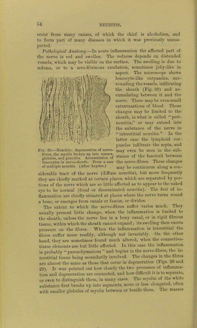 occur from many causes, of which the chief is alcoholism, and to form part of many diseases in which it was previously unsus- pected. Pathological Anatomy.—In acute inflammation the affected part of the nerve is red and swollen. The redness depends on distended vessels, which may be visible on the surface. The swelling is due to cedema, or to a sero-fibrinous exudation, sometimes jelly-like in aspect. The microscope shows leucocyte-like corpuscles, sur- rounding the vessels, infiltrating the sheath (Fig. 39) and ac- cumulating between it and the nerve. There may be even small extravasations of blood. These changes may be limited to the sheath, in what is called  peri- neuritis, or may extend into the substance of the nerve in  interstitial neuritis. In the latter case the lymphoid cor- puscles infiltrate the septa, and may even be seen in the sub- stance of the fasciculi between the nerve-fibres. These changes may be continuous along a con- siderable tract of the nerve (diffuse neuritis), but more frequently they are chiefly marked at certain places, which are separated by por- tions of the nerve which are so little affected as to appear to the naked eye to be normal (focal or disseminated neuritis). The foci of in- flammation are chiefly situated at places where the nerve turns round a bone, or emerges from canals or fasciae, or divides. The extent to which the nerve-fibres suffer varies much. They usually present little change, when the inflammation is limited to the sheath, unless the nerve lies in a bony canal, or in rigid fibrous tissue, within which the sheath cannot expand; its swelling then exerts pressure on the fibres. When the inflammation is interstitial the fibres suffer more readily, although not invariably. On the other hand, they are sometimes found much altered, when the connective- tissue elements are but little affected. In this case the inflammation is probably  parenchymatous  and begins in the nei-ve-fibres, the in- terstitial tissue being secondarily involved. The changes in the fibres are almost the same as those that occur in degeneration (Figs. 28 and 29). It was pointed out how closely the two processes of inflamma- tion and degeneration are connected, and how difficult it is to separate, or even to distinguish them, in many cases. The myelin of the white substance first breaks up into segments, more or less elongated, often with smaller globules of myelin between or beside them. The masses Fig. 39.—Neuritis : degeneration of nerve- fibres, the myelin broken up into masses, globules, and granules. Accumulation of leucocytes in nerve-sheath. From a case of multiple nem-itis. (After Leyden.)