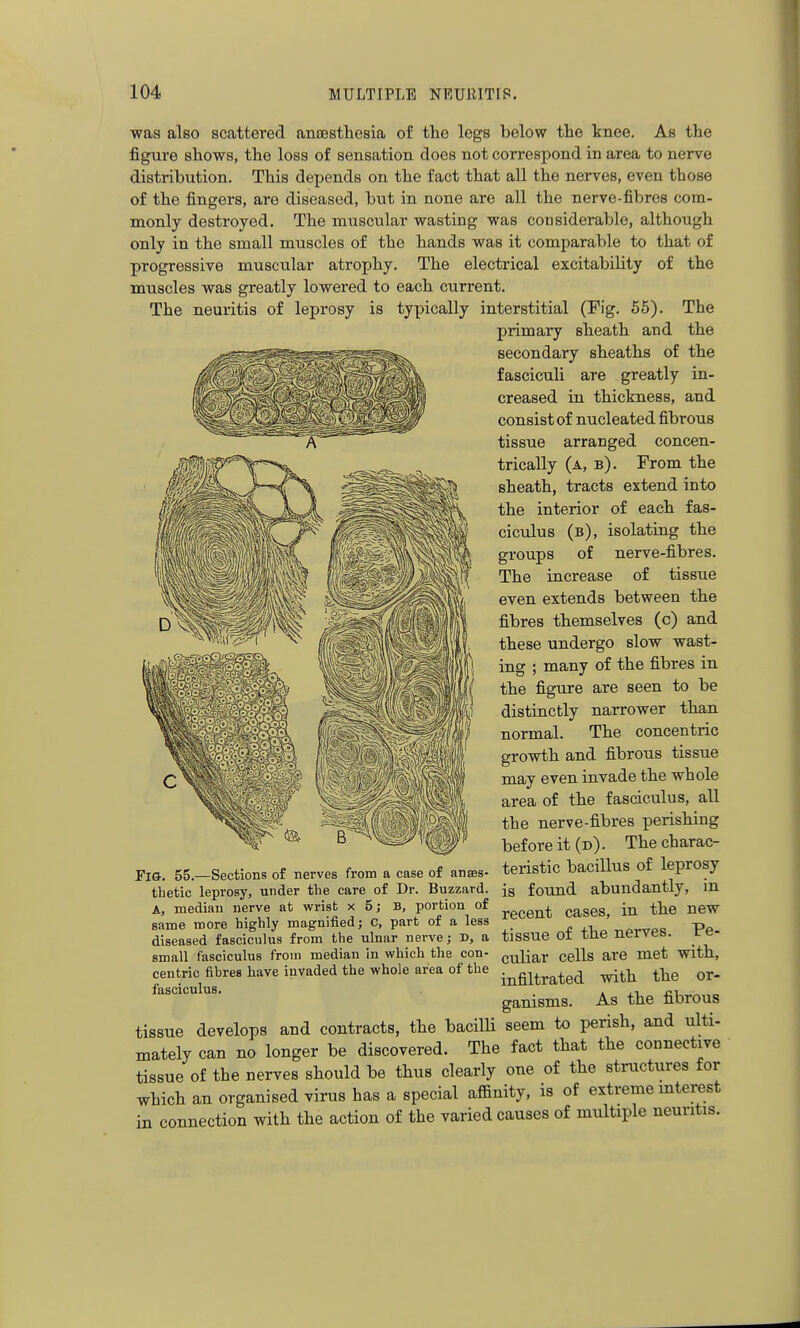 was also scattered anesthesia of the legs below the knee. As the figure shows, the loss of sensation does not correspond in area to nerve distribution. This depends on the fact that all the nerves, even those of the fingers, are diseased, but in none are all the nerve-fibres com- monly destroyed. The muscular wasting was considerable, although only in the small muscles of the hands was it comparable to that of progressive muscular atrophy. The electrical excitability of the muscles was greatly lowered to each current. The neuritis of leprosy is typically interstitial (Fig. 56). The primary sheath and the secondary sheaths of the fasciculi are greatly in- creased in thickness, and consist of nucleated fibrous tissue arranged concen- trically (a, b). From the sheath, tracts extend into the interior of each fas- ciculus (b), isolating the groups of nerve-fibres. The increase of tissue even extends between the fibres themselves (c) and these undergo slow wast- ing ; many of the fibres in the figure are seen to be distinctly narrower than normal. The concentric growth and fibrous tissue may even invade the whole area of the fasciculus, all the nerve-fibres perishing before it (d) . The charac- teristic bacillus of leprosy is found abundantly, in recent cases, in the new tissue of the nerves. Pe- culiar cells are met with, infiltrated with the or- ganisms. As the fibrous FlO. 55.—Sections of nerves from a case of anses- tbetic leprosy, under the care of Dr. Buzzard. A, median nerve at wrist x 5; B, portion of same more highly magnified; C, part of a less diseased fasciculus from the ulnar nerve; D, a small fasciculus from median in which the con- centric fihres have invaded the whole area of the fasciculus. tissue develops and contracts, the bacilli seem to pensh, and ulti- mately can no longer be discovered. The fact that the connective tissue of the nerves should be thus cleariy one of the structures for which an organised virus has a special affinity, is of extreme mterest in connection with the action of the varied causes of multiple neuritis.