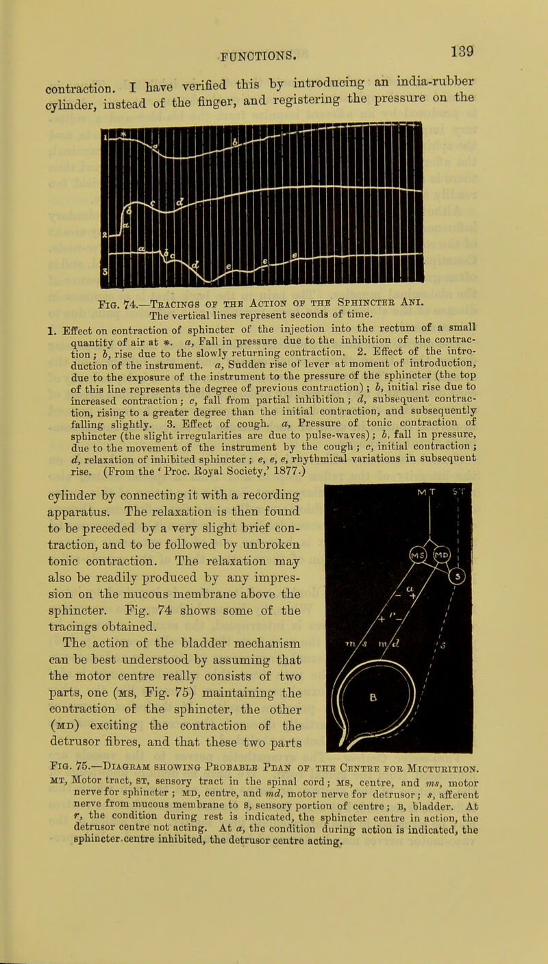 contraction. I have verified this by introducing an india-rubber cylinder, instead of the finger, and registering the pressure on the Fig. 74.—Teacings ov the Action of the Sphincteb Ani. The vertical lines represent seconds of time. 1. Effect on contraction of sphincter of the injection into the rectum of a small quantity of air at #. a. Fall in pressure due to the inhibition of the contrac- tion J b, rise due to the slowly returning contraction. 2. Effect of the intro- duction of the instrument, a. Sudden rise of lever at moment of introduction, due to the exposure of the instrument to the pressure of the sphincter (the top of this line represents the degree of previous contraction) ; b, initial rise due to increased contraction; c, fall from partial inhibition; d, subsequent contrac- tion, rising to a greater degree than the initial contraction, and subsequently falling slightly. 3. Effect of cough, a, Pressure of tonic contraction of sphincter (the slight irregularities are due to pulse-waves); b, fall in pressure, due to the movement of the instrument by the cough ; c, initial contraction ; d, relaxation of inhibited sphincter ; e, e, e, rhythmical variations in subsequent rise. (From the ' Proc. Royal Society,' 1877.) cylinder by connecting it with a recording apparatus. The relaxation is then found to be preceded by a veiy slight brief con- traction, and to be followed by unbroken tonic contraction. The relaxation may also be readily produced by any impres- sion on the mucous membrane above the sphincter. Fig. 74 shows some of the tracings obtained. The action of the bladder mechanism can be best understood by assuming that the motor centre really consists of two parts, one (ms, Fig. 75) maintaining the contraction of the sphincter, the other (mo) exciting the contraction of the detrusor fibres, and that these two parts Fig. 75.—Diageam showing Peobablb Pbak of the Centre foe Micturition. MT, Motor tract, ST, sensory tract in the spinal cord; MS, centre, and ms, motor nerve for sphincter ; md, centre, and md, motor nerve for detrusor; *, afferent nerve from mucous membrane to S, sensory portion of centre; B, bladder. At r, the condition during rest is indicated, the sphincter centre in action, the detrusor centre not acting. At a, the condition during action is indicated, the Bphincter.centre inhibited, the detrusor centre acting.