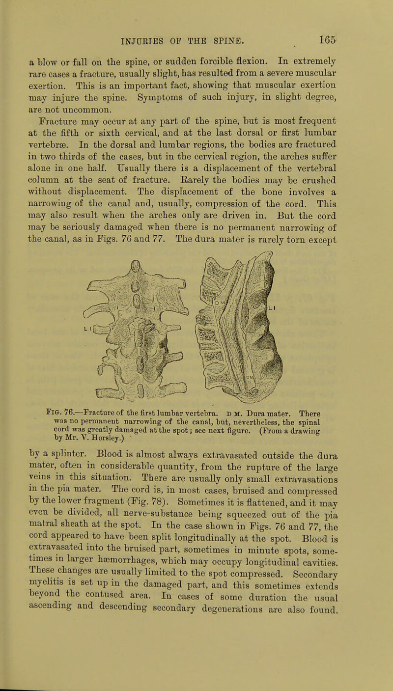 a blow or fall on tlie spine, or sudden forcible flexion. In extremely- rare cases a fracture, usually slight, has resulted from a severe muscular exertion. This is an important fact, showing that muscular exertion may injure the spine. Symptoms of such injury, in slight degree, are not uncommon. Fracture may occur at any part of the spine, but is most frequent at the fifth or sixth cervical, and at the last dorsal or first lumbar vertebrae. In the dorsal and lumbar regions, the bodies are fractured in two thirds of the cases, but in the cervical region, the arches suffer alone in one half. Usually there is a displacement of the vertebi-al column at the seat of fracture. Rarely the bodies may be crushed without displacement. The displacement of the bone involves a narrowing of the canal and, usually, compression of the cord. This may also result when the arches only are driven in. But the cord may be seriously damaged when there is no permanent narrowing of the canal, as in Figs. 76 and 77. The dura mater is rarely torn except Fig. 76.—Fracture of the first lumbar vertebra. D M. Dura mater. There was no permanent narrowing of the canal, but, nevertheless, the spinal cord was greatly damaged at the spot: see next fis-ure. (From a drawine by Mr. V. Horsley.) o v e by a splinter. Blood is almost always extravasated outside the dura mater, often in considerable quantity, from the rupture of the large veins in this situation. There are usually only small extravasations in the pia mater. The cord is, in most cases, bruised and compressed by the lower fragment (Fig. 78). Sometimes it is flattened, and it may even be divided, all nerve-substance being squeezed out of the pia matral sheath at the spot. In the case shown in Figs. 76 and 77, the cord appeared to have been split longitudinally at the spot. Blood is extravasated into the bruised part, sometimes in minute spots, some- times in larger haemorrhages, which may occupy longitudinal cavities. These changes are usually limited to the spot compressed. Secondary myelitis is set up in the damaged part, and this sometimes extends beyond the contused area. In cases of some duration the usual ascendmg and descending secondary degenerations are also found.