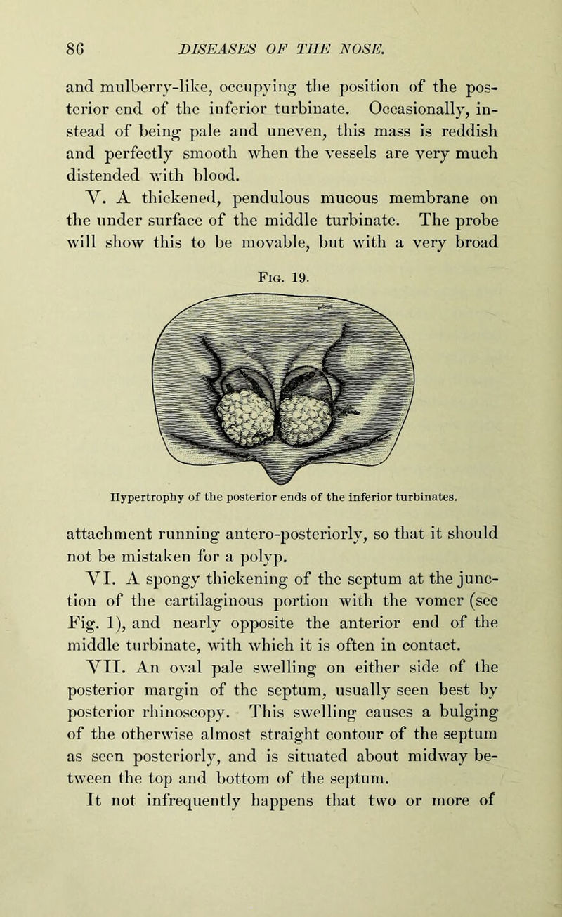 and mulberiy-like, occupying the position of the pos- terior end of the inferior turbinate. Occasionally, in- stead of being pale and uneven, this mass is reddish and perfectly smooth when the vessels are very much distended with blood. V. A thickened, pendulous mucous membrane on the under surface of the middle turbinate. The probe will show this to be movable, but with a very broad Fig. 19. Hypertrophy of the posterior ends of the inferior turbinates. attachment running antero-posteriorly, so that it should not be mistaken for a polyp. VI. A spongy thickening of the septum at the junc- tion of the cartilaginous portion with the vomer (see Fig. 1), and nearly opposite the anterior end of the middle turbinate, with which it is often in contact. VII. An oval pale swelling on either side of the posterior margin of the septum, usually seen best by posterior rhino.scopy. This swelling causes a bulging of the otherwise almost straight contour of the septum as seen posteriorly, and is situated about midway be- tween the top and bottom of the septum. It not infrequently happens that two or more of