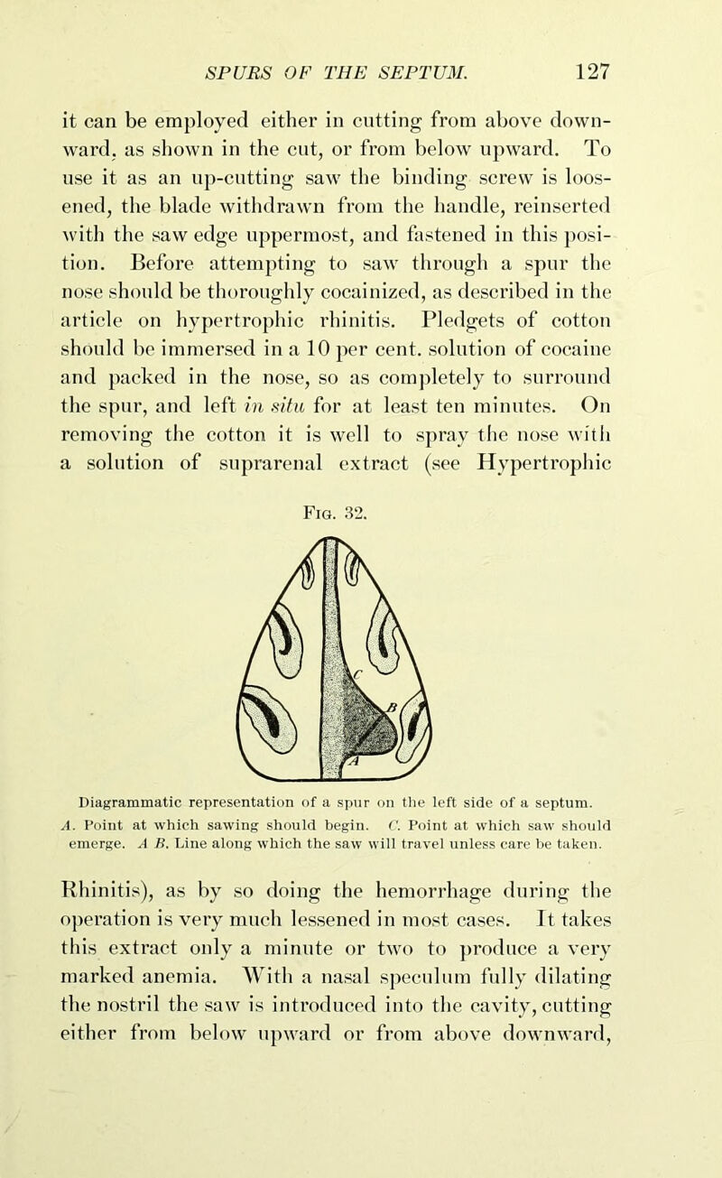 it can be employed either in cutting from above down- ward. as shown in the cut, or from below upward. To use it as an up-cutting saw the binding .screw is loos- ened, the blade withdrawn from the handle, reinserted \vith the saw edge uppermost, and fastened in this j)osi- tion. Befoi’e attempting to .saw through a spur the nose should be thoroughly cocainized, as described in the article on hypertrophic rhinitis. Pledgets of cotton should be immersed in a 10 per cent, solution of cocaine and packed in the nose, so as completely to surround the spur, and left hi situ for at least ten minutes. On removing the cotton it is well to spray the nose with a solution of suprarenal extract (see Hypertrophic Fig. 32. Diagrammatic representation of a spur on the left side of a septum. A. Point at which sawing should begin. C. Point at which saw should emerge. A R. Line along which the saw will travel unless care be taken. Rhinitis), as by so doing the hemorrhage during the operation is very much lessened in most cases. It takes this extract only a minute or two to ])roduce a very marked anemia. With a nasal speculum fully dilating the nostril the saw is introduced into the cavity, cutting either from below upward or from above downward,