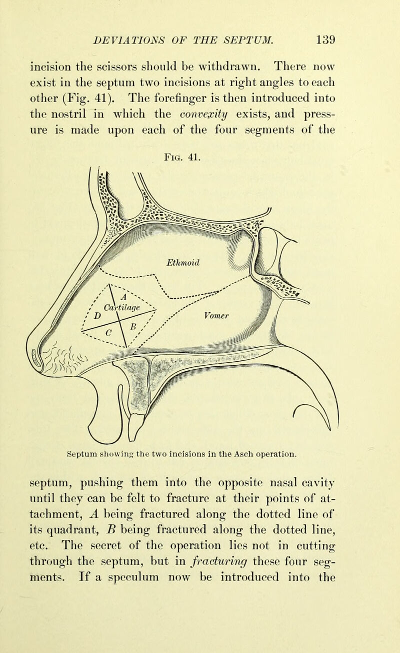 incision the scissors should be withdrawn. There now exist in the septum two incisions at right angles to each other (Fig. 41). The forefinger is then introduced into the nostril in which the convexity exists, and press- ure is made upon each of the four segments of the Fig. 41. septum, pushing them into the opposite nasal cavity until they can be felt to fracture at their points of at- tachment, A being fractured along the dotted line of its quadrant, B being fractured along the dotted line, etc. The secret of the operation lies not in cutting through the septum, but in fracturing these four seg- ments. If a speculum now be introduced into the