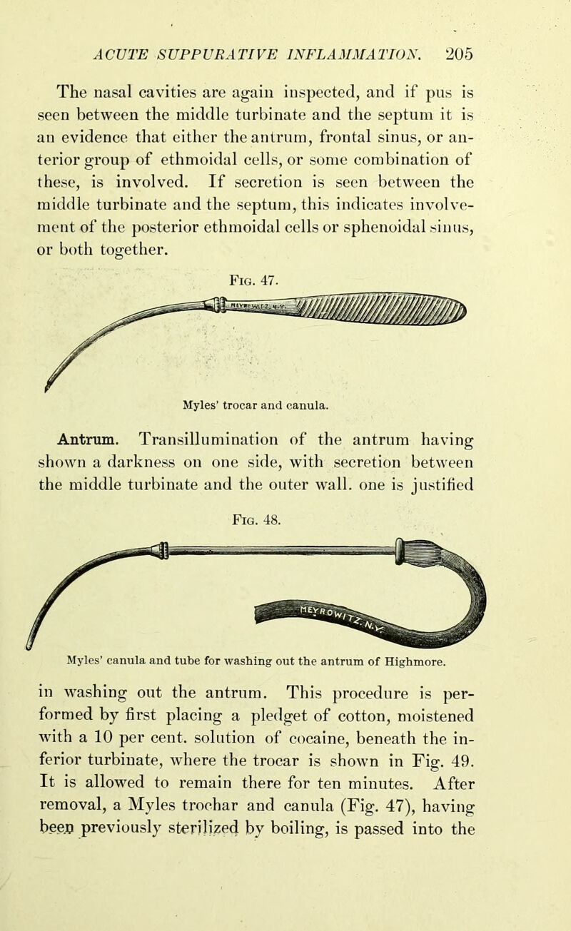 The nasal cavities are again inspected, and if pus is seen between the middle turbinate and the septum it is an evidence that either the antrum, frontal sinus, or an- terior group of ethmoidal cells, or some combination of these, is involved. If secretion is seen between the middle turbinate and the septum, this indicates involve- ment of the posterior ethmoidal cells or sphenoidal sinus, or both together. Fig. 47. Antrum. Transillumination of the antrum having shown a darkness on one side, with secretion between the middle turbinate and the outer wall, one is justified Fig. 48. Myles’ canula and tube for washing out the antrum of Highmore. in washing out the antrum. This procedure is per- formed by first placing a pledget of cotton, moistened with a 10 per cent, solution of cocaine, beneath the in- ferior turbinate, where the trocar is shown in Fig. 49. It is allowed to remain there for ten minutes. After removal, a Myles trochar and canula (Fig. 47), having bee.o previously sterilized by boiling, is passed into the