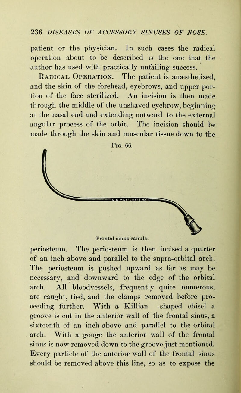 patient or the physician. In such cases the radical operation about to be described is the one that the author has used with practically unfailing success. Radical Operation. The patient is anaesthetized, and the skin of the forehead, eyebrows, and upper por- tion of the face sterilized. An incision is then made through the middle of the unshaved eyebrow, beginning at the nasal end and extending outward to the external angular process of the orbit. The incision should be made through the skin and muscular tissue down to the Fig. 66. periosteum. The periosteum is then incised a quarter of an inch above and parallel to the supra-orbital arch. The periosteum is pushed upward as far as may be necessary, and downward to the edge of the orbital arch. All bloodvessels, frequently quite numerous, are caught, tied, and the clamps removed before pro- ceeding further. With a Killian -shaped chisel a groove is cut in the anterior wall of the frontal sinus, a sixteenth of an inch above and parallel to the orbital arch. With a gouge the anterior wall of the frontal sinus is now removed down to the groove just mentioned. Every particle of the anterior wall of the frontal sinus should be removed above this line, so as to expose the