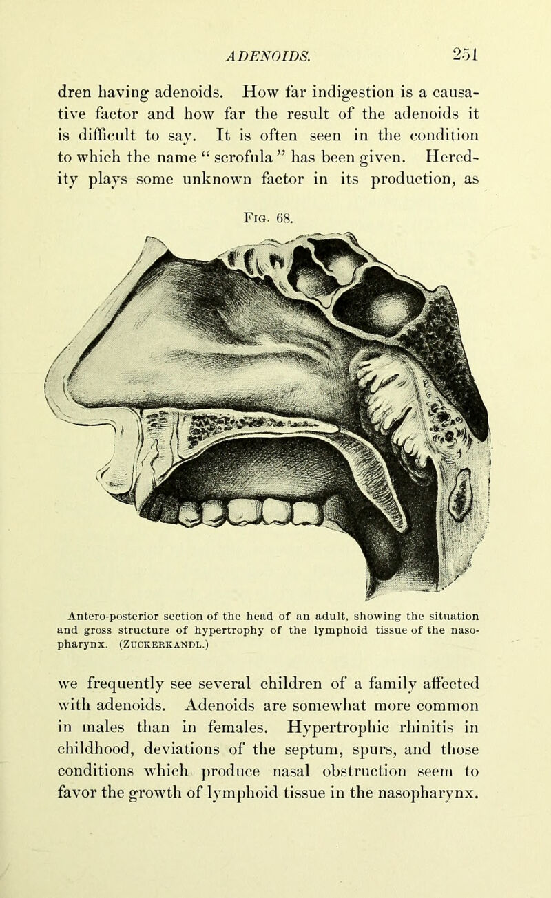 dren having adenoids. How far indigestion is a causa- tive factor and how far the result of the adenoids it is difficult to say. It is often seen in the condition to which the name “ scrofula ” has been given. Hered- ity plays some unknown faetor in its production, as Fig. 68. Antero-posterior section of the head of an adult, showing the situation and gross structure of hypertrophy of the lymphoid tissue of the naso- pharynx. (ZUCKERKANDL.) we frequently see several children of a family affected with adenoids. Adenoids are somewhat more common in males than in females. Hypertrophic rhinitis in childhood, deviations of the septum, spurs, and those conditions which produce nasal obstruction seem to favor the growth of lymphoid tissue in the nasopharynx.