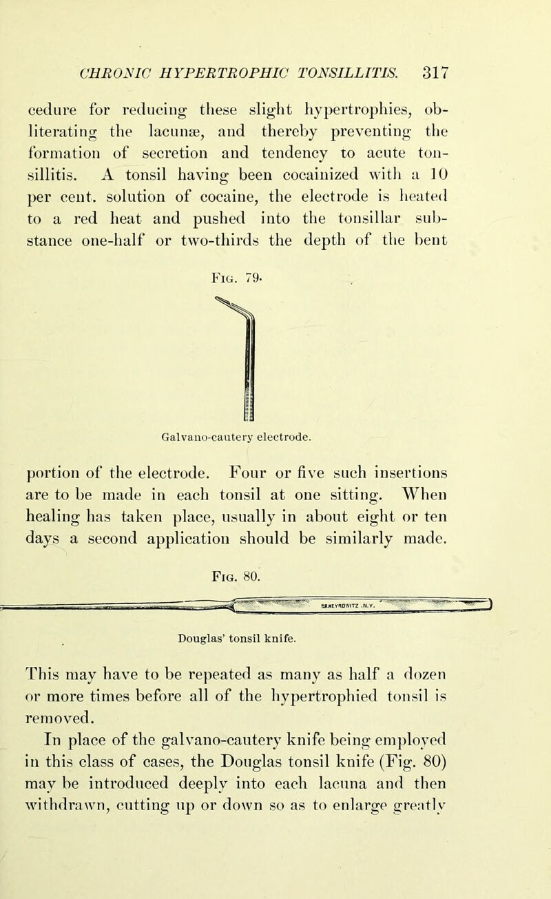 cedure for reducing these slight hypertrophies, ob- literating the lacunae, and thereby preventing the formation of secretion and tendency to acute ton- sillitis. A tonsil having been cocainized with a 10 per cent, solution of cocaine, the electrode is heated to a red heat and pushed into the tonsillar sub- stance one-half or two-thirds the depth of the bent Fig. 79- Galvano-cautery electrode. portion of the electrode. Four or five such insertions are to be made in each tonsil at one sitting. When healing has taken place, usually in about eight or ten days a second application should be similarly made. Fig. 80. Douglas’ tonsil knife. This may have to be repeated as many as half a dozen or more times before all of the hypertrophied tonsil is removed. In place of the galvano-cautery knife being employed in this class of ca.ses, the Douglas tonsil knife (Fig. 80) may be introduced deeply into each lacuna and then withdrawn, cutting up or down so as to enlarge greatly