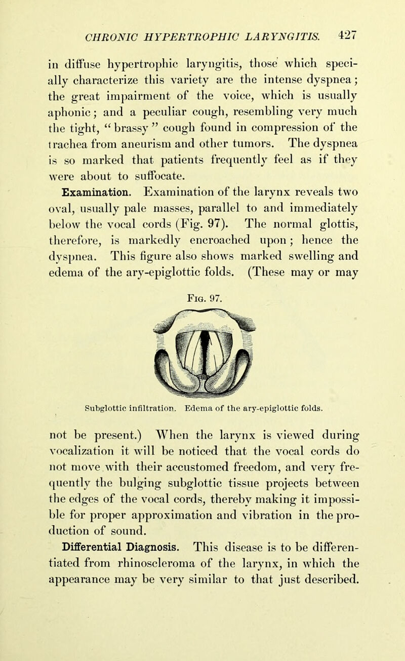 in diffuse hypertrophic laryngitis, those which speci- ally characterize this variety are the intense dyspnea; the great impairment of the voice, which is usually aphonic; and a peculiar cough, resembling very much the tight, brassy ” cough found in compression of the t rachea from aneurism and other tumors. The dyspnea is so marked that patients frequently feel as if they were about to suffocate. Examination. Examination of the larynx reveals two oval, usually pale masses, parallel to and immediately below the vocal cords (Fig. 97). The normal glottis, therefore, is markedly encroached upon; hence the dyspnea. This figure also shows marked swelling and edema of the ary-epiglottic folds. (These may or may Fig. 97. Subglottic infiltration. Edema of the ary-epiglottic folds. not be present.) When the larynx is viewed during vocalization it will be noticed that the vocal cords do not move with their accustomed freedom, and very fre- quently the bulging subglottic tissue projects between the edges of the vocal cords, thereby making it impossi- ble for proper approximation and vibration in the pro- duction of sound. Differential Diagnosis. This disease is to be differen- tiated from rhinoscleroma of the larynx, in which the appearance may be very similar to that just described.