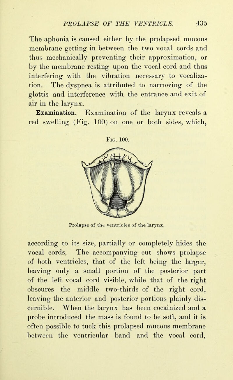 PROLAPSE OF THE VENTRICLE. 4;35 The aphonia is caused either by the prolapsed mucous membrane getting in between the two vocal cords and thus mechanically preventing their approximation, or by the membrane resting upon the vocal cord and thus interfering with the vibration necessary to vocaliza- tion. The dyspnea is attributed to narrowing of the glottis and interference with the entrance and exit of air in the larynx. Examination. Examination of the larynx reveals a red swelling (Fig. 100) on one or both sides, which, Fig. 100. Prolapse of the ventricles of the larynx. according to its size, partially or completely hides the vocal cords. The accompanying cut shows prolapse of both ventricles, that of the left being the larger, leaving only a small portion of the posterior part of the left vocal cord visible, while that of the right obscures the middle two-thirds of the right cord, leaving the anterior and posterior portions plainly dis- cernible. When the larynx has been cocainized and a probe introduced the mass is found to be soft, and it is often possible to tuck this prolapsed mucous membrane between the ventricular band and the vocal cord,