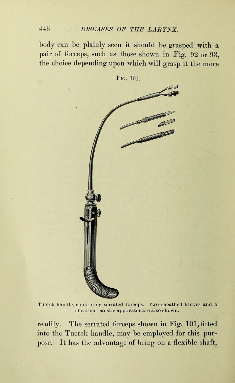 Tuerck handle, eoiitaiiiing serrated forceps. Two sheathed knives and a sheathed caustic applicator are also shown. readily. The serrated forceps shown in Fig. 101, fitted into the Tuerck handle, may be employed for this pur- pose. It has the advantage of being on a flexible shaft, body can be plainly seen it should be grasped with a pair of forceps, such as those shown in Fig. 92 or 93, the choice depending upon which will grasp it the more Fig. 101.