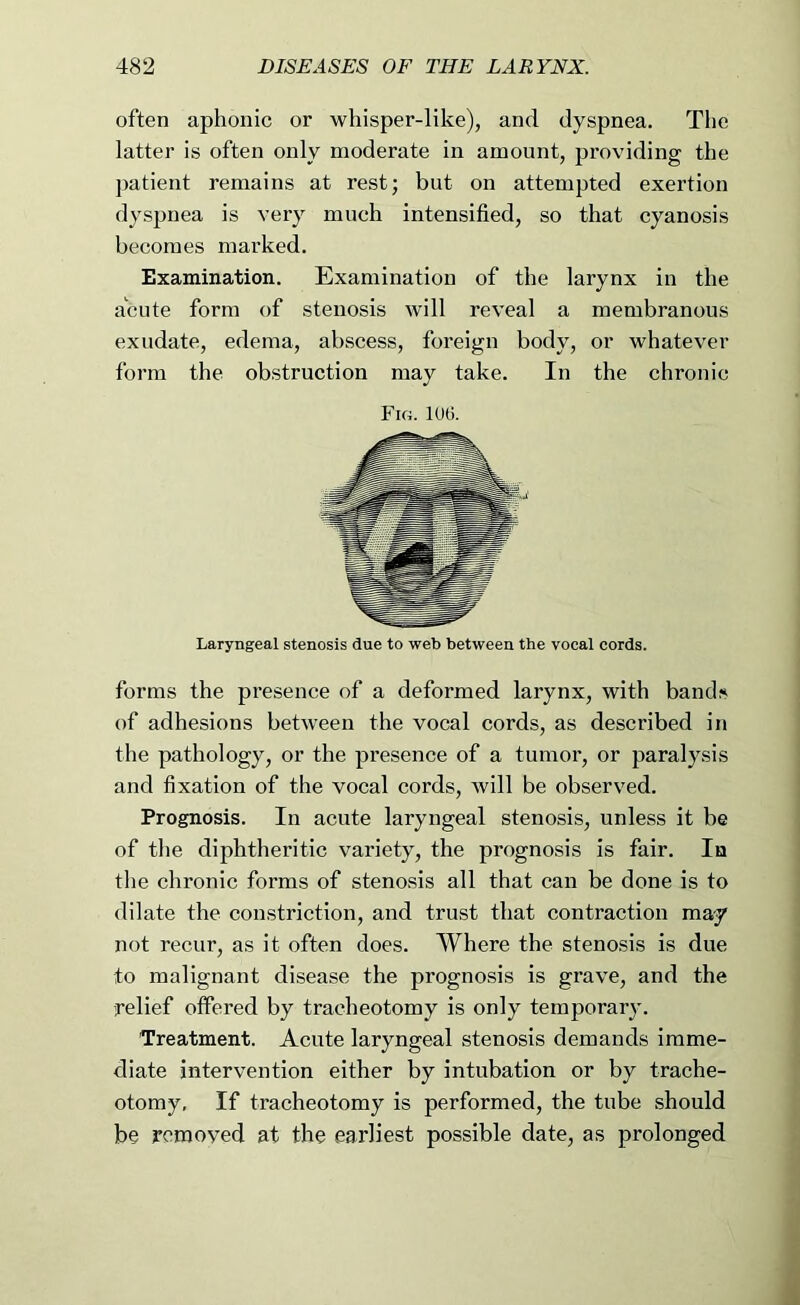 often aphonic or whisper-like), and dyspnea. The latter is often only moderate in amount, providing the patient remains at rest; but on attempted exertion dyspnea is very much intensified, so that cyanosis becomes marked. Examination. Examination of the larynx in the acute form of stenosis will reveal a membranous exudate, edema, abscess, foreign body, or whatever form the obstruction may take. In the chronic Fig. 106. Laryngeal stenosis due to web between the vocal cords. forms the presence of a deformed larynx, with bandf< of adhesions between the vocal cords, as described in the pathology, or the presence of a tumor, or paralysis and fixation of the vocal cords, will be observed. Prognosis. In acute laryngeal stenosis, unless it be of the diphtheritic variety, the prognosis is fair. In the chronic forms of stenosis all that can be done is to dilate the constriction, and trust that contraction may not recur, as it often does. Where the stenosis is due to malignant disease the prognosis is grave, and the relief offered by tracheotomy is only temporary. Treatment. Acute laryngeal stenosis demands imme- diate intervention either by intubation or by trache- otomy, If tracheotomy is performed, the tube should be removed at the earliest possible date, as prolonged