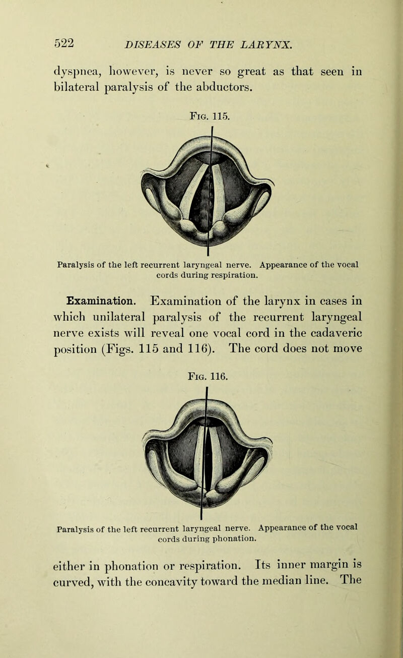 dyspnea, however, is never so great as that seen in bilateral paralysis of the abductors. Fig. 115. Paralysis of the left recurrent laryngeal nerve. Appearance of the vocal cords during respiration. Examination. Examination of the larynx in cases in which unilateral paralysis of the recurrent laryngeal nerve exists will reveal one vocal cord in the cadaveric position (Figs. 115 and 116). The cord does not move Fig. 116. Paralysis of the left recurrent laryngeal nerve. Appearance of the vocal cords during phonation. either in phonation or respiration. Its inner margin is curved, with the concavity toward the median line. The
