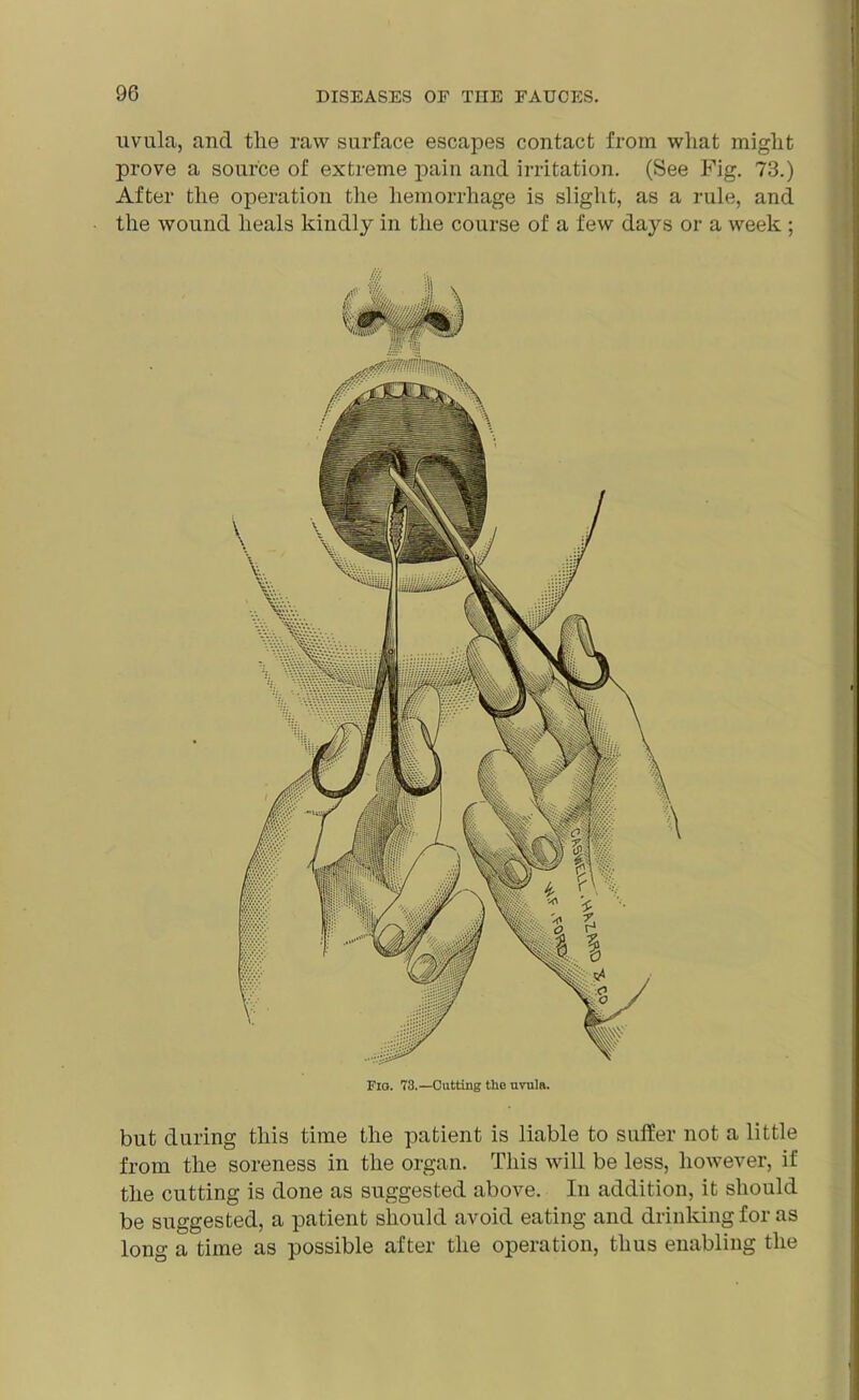 uvula, and the raw surface escapes contact from what might prove a source of extreme pain and irritation. (See Fig. 73.) After the operation the hemorrhage is slight, as a rule, and the wound heals kindly in the course of a few days or a week ; Fig. 73.—Cutting the uvula. but during this time the patient is liable to suffer not a little from the soreness in the organ. This will be less, however, if the cutting is done as suggested above. In addition, it should be suggested, a patient should avoid eating and drinking for as long a time as possible after the operation, thus enabling the