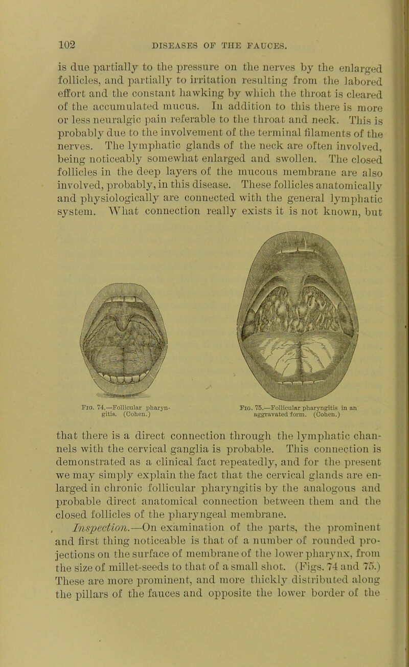 is due partially to the pressure on the nerves by the enlarged follicles, and partially to irritation resulting from the labored effort and the constant hawking by which the throat is cleared of the accumulated mucus. In addition to this there is more or less neuralgic pain referable to the throat and neck. This is probably due to the involvement of the terminal filaments of the nerves. The lymphatic glands of the neck are often involved, being noticeabty somewhat enlarged and swollen. The closed follicles in the deep layers of the mucous membrane are also involved, probably, in this disease. These follicles anatomically and physiologically are connected with the general lymphatic system. What connection really exists it is not known, but Fig. 74.—Follicular pharyn- Fig. 75.—Follicular pharyngitis in an gitis. (Cohen.) aggravated form. (Cohen.) that there is a direct connection through the lymphatic chan- nels with the cervical ganglia is probable. This connection is demonstrated as a clinical fact repeatedly, and for the present we may simply explain the fact that the cervical glands are en- larged in chronic follicular pharyngitis by the analogous and probable direct anatomical connection between them and the closed follicles of the pharyngeal membrane. Inspection.—On examination of the parts, the prominent and first tiling noticeable is that of a number of rounded pro- jections on the surface of membrane of the lower pharynx, from the size of millet-seeds to that of a small shot. (Figs. 74 and 75.) These are more prominent, and more thickly distributed along the pillars of the fauces and opposite the lower border of the