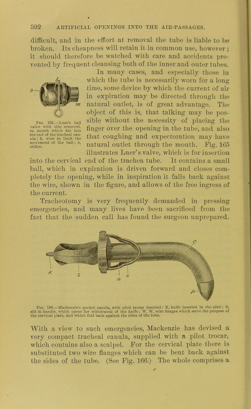 difficult, and in tlie effort at removal the tube is liable to be broken. Its cheapness will retain it in common use, however ; it should therefore be watched with care and accidents pre- vented by frequent cleansing both of the inner and outer tubes. In many cases, and especially those in which the tube is necessarily worn for a long time, some device by which the current of air in expiration may be directed through the natural outlet, is of great advantage. The object of this is, that talking may be pos- sible without the necessity of placing the finger over the opening in the tube, and also that coughing and expectoration may have natural outlet through the mouth. Fig. 165 illustrates Luer’s valve, which is for insertion into the cervical end of the trachea tube. It contains a small ball, which in expiration is driven forward and closes com- pletely the opening, while in inspiration it falls back against the wire, shown in the figure, and allows of the free ingress of the current. Tracheotomy is very frequently demanded in pressing emergencies, and many lives have been sacrificed from the fact that the sudden call has found the surgeon unprepared. 4 Fig. 165.—Luer’s ball valve with side removed. to, mouth which fits into the end of the tracheal can- ulu; 6, wire to limit the movement of the ball; o, orifice. Fig. Kill.—Mackenzie’s pocket canula, with pilot trocar inserted: K, knife inserted in the pilot; S. slit in handle, which opens for withdrawal of the knife ; IV, W. wire flanges which servo the purpose of the cervical plate, and which fold back ugainst the sides of the tube. With a view to such emergencies, Mackenzie has devised a very compact tracheal canula, supplied with a pilot trocar, which contains also a scalpel. For the cervical plate there is substituted two wire flanges which can be bent back against the sides of the tube. (See Fig. 166.) The whole comprises a