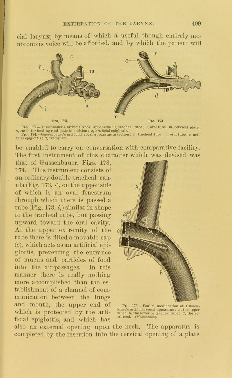 cial larynx, by means of which a useful though entirely mo- notonous voice will be afforded, and by which the patient will Fig. 173. Fig. 174. Fig. 173.—Gussenbauer’s artificial vocal apparatus: i, tracheal tube ; l, oral tube; m, cervical plate; n, catch for holding reed-plate in position ; c, artificial epiglottis. Fig. 174.—Gussenbauer’s artificial vocal apparatus in section: n, tracheal tube ; o, oral tube; c, arti- ficial epiglottis; cl, reed-plate. be enabled to carry on conversation with comparative facility. The first instrument of this character which was devised was that of Grussenbauer, Figs. 173, 174. This instrument consists of an ordinary double tracheal can- ula (Fig. 173, i), on the upper side of which is an oval fenestrum through which there is passed a tube (Fig. 173, l,) similar in shape to the tracheal tube, but passing upward toward the oral cavity. At the upper extremity of the tube there is filled a movable cap (c), which acts as an artificial epi- glottis, preventing the entrance of mucus and particles of food into the air-passages. In this manner there is really nothing more accomplished than the es- tablishment of a channel of com- munication between the lungs and mouth, the upper end of which is protected by the arti- ficial epiglottis, and which has also an external opening upon the neck. The apparatus is completed by the insertion into the cervical opening of a plate Fig. 175. —Foulls’ modification of Gussen- bnucr’s artificial vocal apparatus: A, the upper tube ; U, the lower or tracheal tube ; C, the vo- cal reed. (Mackenzie).