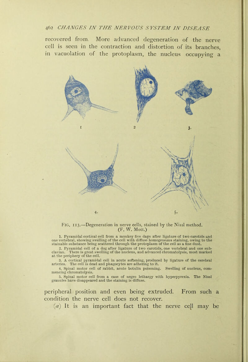 recovered from. More advanced degeneration of the nerve cell is seen in the contraction and distortion of its branches, in vacuolation of the protoplasm, the nucleus occupying a Fig. 113.—Degeneration in nerve cells, stained by the Nissl method. (F. VV. Mott.) 1. Pyramidal cortical cell from a monkey five days after ligature of two carotids and one vertebral, showing s\\ elling of the cell with diffuse homogeneous staining, owing to the stainable substance being scattered through the protoplasm of the cell as a flue dust. 2. Pyramidal cell of a dog after ligature of two carotids, one vertebral and one sub- clavian. There is great swelling of the nucleus, and advanced chromatolysis, most marked at the periphery of the cell. 3. A cortical pyramidal cell in acute softening, produced by ligature of the cerebral arteries. The cell is dead and phagocytes are adhering to it. 4. Sj)inal motor cell of rabbit, acute botulin poisoning. Swelling of nucleus, com- mencing chromatolysis. 5. Spinal motor cell from a case of negro lethargy with hyperpyrexia. The Nissl granules have disappeared and the staining is diffuse. peripheral position and even being extruded. From such a condition the nerve cell does not recover. (rz) It is an important fact that the nerve cell may be