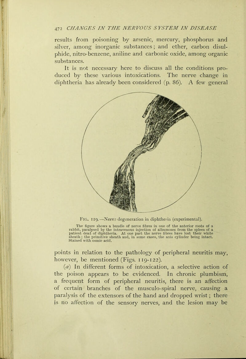 results from poisoning by arsenic, mercury, phosphorus and silver, among inorganic substances; and ether, carbon disul- phide, nitro-benzene, aniline and carbonic oxide, among organic substances. It is not necessary here to discuss all the conditions pro- duced by these various intoxications. The nerve change in diphtheria has already been considered (p. 86). A few general Fig. 119.—Nerve degeneration in diphtheiia (experimental). The figure shows a bundle of ner\-e fibres in one of the anterior roots of a rabbit, paralysed by the intravenous injection of albumoses from the spleen of a patient dead of diphtheria. At one part the nerve fibres Imve lost their white sheath ; the primitive sheath and, in some cases, the axis cylinder being intact. Stained with osmic acid. points in relation to the pathology of peripheral neuritis may, however, be mentioned (Figs. 119-122). {a) In different forms of intoxication, a selective action of the poison appears to be evidenced. In chronic plumbism, a frequent form of peripheral neuritis, there is an affection of certain branches of the musculo-spiral nerve, causing a paralysis of the extensors of the hand and dropped wrist; there is no affection of the sensory nerves, and the lesion may be