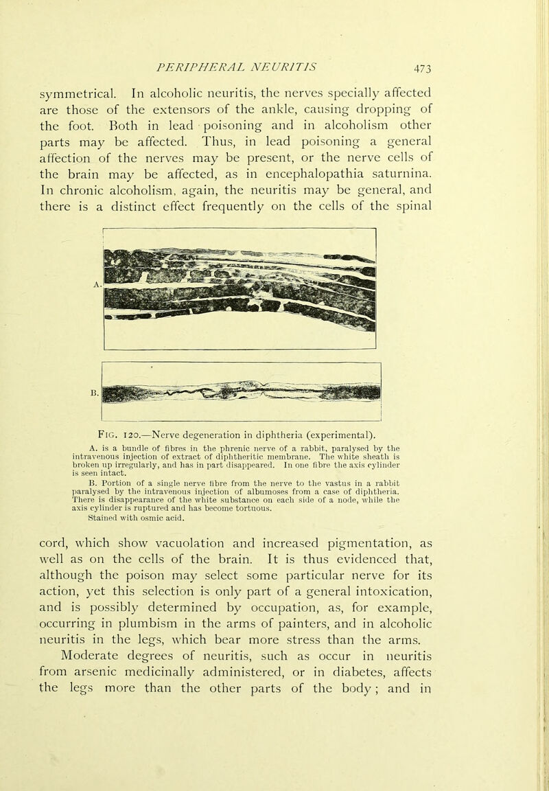 symmetrical. In alcoholic neuritis, the nerves specially affected are those of the extensors of the ankle, causing dropping of the foot. Both in lead poisoning and in alcoholism other parts may be affected. Thus, in lead poisoning a general affection of the nerves may be present, or the nerve cells of the brain may be affected, as in encephalopathia saturnina. In chronic alcoholism, again, the neuritis may be general, and there is a distinct effect frequently on the cells of the spinal B. Fig. 120.—Nerve degeneration in diphtheria (experimental). A. is a bundle of fibres in tlie phrenic nerve of a rabbit, paralysed by the intravenous injection of extract of diplitheritic membrane. Tlie wliite .slieath is broken up irregularly, and has in part disappeared. In one fibre the axis cylinder is seen intact. B. Portion of a single nerve libre from the nerve to the vastus in a rabbit ]iaralysed by the intravenous infection of albumoses from a case of diplitheria. There is disappearance of the wliite substance on each side of a node, while the axis cylinder is ruptured and has become tortuous. stained with osmic acid. cord, which show vacuolation and increased pigmentation, as well as on the cells of the brain. It is thus evidenced that, although the poison may select some particular nerve for its action, yet this selection is only part of a general intoxication, and is possibly determined by occupation, as, for example, occurring in plumbism in the arms of painters, and in alcoholic neuritis in the legs, which bear more stress than the arms. Moderate degrees of neuritis, such as occur in neuritis from arsenic medicinally administered, or in diabetes, affects the legs more than the other parts of the body; and in