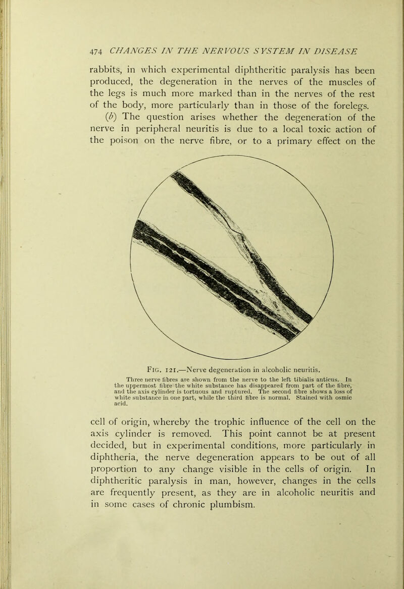 rabbits, in which experimental diphtheritic paralysis has been produced, the degeneration in the nerves of the muscles of the legs is much more marked than in the nerves of the rest of the body, more particularly than in those of the forelegs. ib) The question arises whether the degeneration of the nerve in peripheral neuritis is due to a local toxic action of the poison on the nerve fibre, or to a primary effect on the Fig. I2I.—Nerve degeneration in alcoholic neuritis. Three nerve fibres are sliown from the nerve to the left tibialis antieiis. In the uppermost fibre the white substance has disappeared from i)art of the fibre, and tiie axis cylinder is tortuous and ruplured. The second fibre shows a loss of wliite substance in one part, while the third fibre is normal. Stained with osmic acid. cell of origin, whereby the trophic influence of the cell on the axis cylinder is removed. This point cannot be at present decided, but in experimental conditions, more particularly in diphtheria, the nerve degeneration appears to be out of all proportion to any change visible in the cells of origin. In diphtheritic paralysis in man, however, changes in the cells are frequently present, as they are in alcoholic neuritis and in some cases of chronic plumbism.