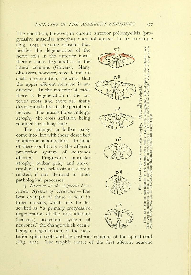 The condition, however, in chronic anterior poliomyelitis (pro- gressive muscular atrophy) does not appear to be so simple (Fig. 124), as some consider that besides the degeneration of the nerve cells in the anterior horns there is some degeneration in the lateral columns (Gowers). Many observers, however, have found no such degeneration, showing that the upper efferent neurone is un- affected. In the majority of cases there is degeneration in the an- terior roots, and there are many degenerated fibres in the peripheral nerves. The muscle fibres undergo atrophy, the cross striation being retained for a long time. The changes in bulbar palsy come into line with those described in anterior poliomyelitis. In none of these conditions is the afferent projection system of neurones affected. Progressive muscular atrophy, bulbar palsy and amyo- trophic lateral sclerosis are closely related, if not identical in their pathological processes. 3. Diseases of the Afferent Pro- jection System of Neuro)ies.—'I'he best example of these is seen in tabes dorsalis, which may be de- scribed as “ a primary progressive degeneration of the first afferent (sensory) projection system of neurones,” the change which occurs being a degeneration of the pos- terior spinal roots and the posterior columns of the spinal cord (Fig. 125). The trophic centre of the first afferent neurone