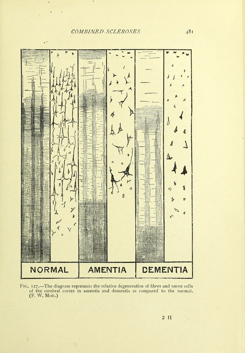 Fig. 127.—The diagram represents the relative degeneration of fibres and nerve cells of the cerebral cortex in amentia and dementia as compared to the normal. (F.. W. Mott.) 2 H