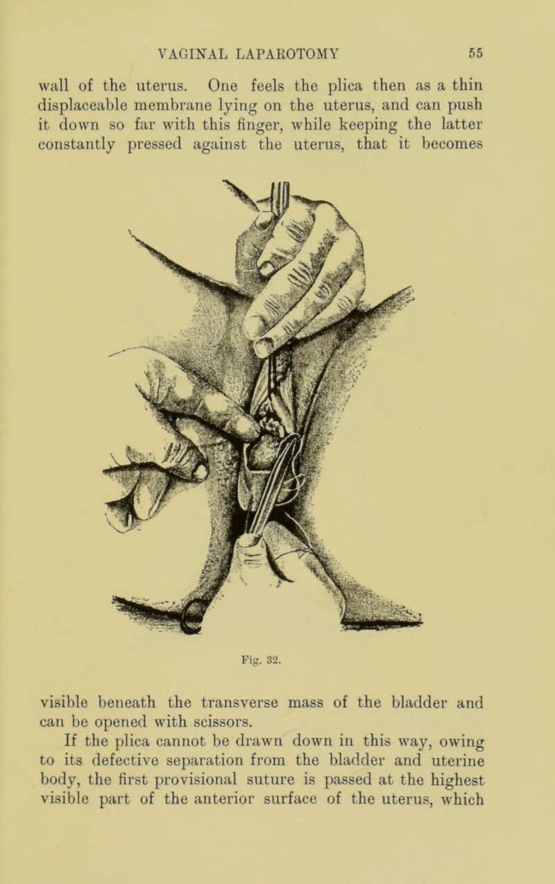 wall of the uterus. One feels the plica then as a thin displaceable membrane lying on the uterus, and can push it down so far with this finger, while keeping the latter constantly pressed against the uterus, that it becomes Fig. 32. visible beneath the transverse mass of the bladder and can be opened with scissors. If the plica cannot be drawn down in this way, owing to its defective separation from the bladder and uterine body, the first provisional suture is passed at the highest visible part of the anterior surface of the uterus, which