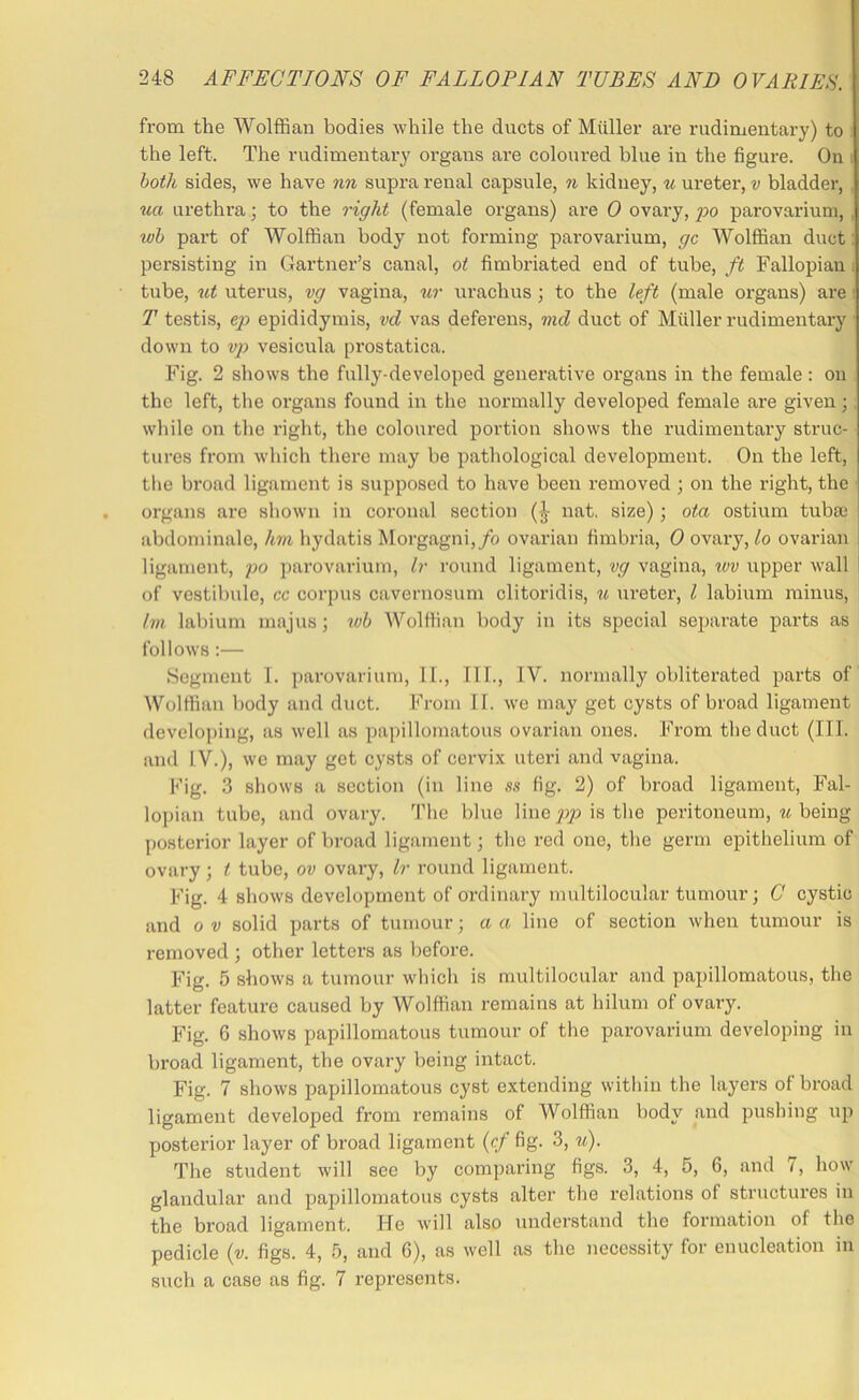 from the WolflBan bodies Avhile the ducts of Muller are rudimentary) to the left. The rudimentai’y organs are coloured blue in the figure. On both sides, we have nn supra renal capsule, n kidney, u ui’etei’, v bladder, ua urethra ■, to the right (female organs) are 0 ovary, po parovarium, , wh pai't of Wolffian body not forming parovarium, gc Wolffian duct: persisting in Gartner’s canal, ot fimbriated end of tube, ft Fallopian i tube, ut uterus, vg vagina, ur urachus ; to the left (male organs) are • T testis, e}) epididymis, vd vas deferens, md duct of Muller rudimentary down to vp vesicula pi'ostatica. Fig. 2 shows the fully-developed generative organs in the female: on the left, tlie organs found in the normally developed female are given; while on the riglit, the coloured portion shows the rudimentai’y struc- tures from which there may be pathological development. On the left, the broad ligament is supposed to have been removed ; on the right, the organs are sliown in coronal section (J nat. size); ota ostium tubaj ; abdominale, hm hydatis Morgagni,/o ovarian fimbria, 0 ovary, lo ovarian i ligament, po parovarium, Ir round ligament, vg vagina, %vv upper wall i of vestibule, cc corpus cavernosum clitoridis, « ureter, I labium minus, Im labium majus; %ob Wolffian body in its special separate parts as follows :— Segment 1. parovarium, II., 111., IV. normally obliterated parts of Wolffian body and duct. From 11. we may get cysts of broad ligament devclo])ing, as well as papillomatous ovarian ones. From the duct (III. and IV.), we may get cysts of cervix uteri and vagina. Fig. 3 shows a section (in line ss fig. 2) of broad ligament, Fal- lojiian tube, and ovary. The blue line jiip is the peritoneum, m being posterior layer of broad ligament; the red one, the germ epithelium of ovary ; t tube, ov ovary, Ir round ligament. Fig. 4 shows development of ordinary multilocular tumour; G cystic and 0 V solid parts of tumour; a a line of section Avhen tumour is removed ; other letters as before. Fig. 5 shows a tumour which is multilocular and papillomatous, the latter feature caused by Wolffian remains at hilum of ovary. Fig. 6 shows papillomatous tumour of the parovarium developing in broad ligament, the ovary being intact. Fig. 7 shows papillomatous cyst extending within the layers of broad ligament developed from remains of Wolffian body and pushing up posterior layer of broad ligament (cf fig. 3, u). The student will see by comparing figs. 3, 4, 5, 6, and i, how glandular and papillomatous cysts alter the relations of structures in the broad ligament. He ivill also understand the formation of the pedicle {v. figs. 4, 5, and 6), as well as the necessity for enucleation in such a case as fig. 7 represents.