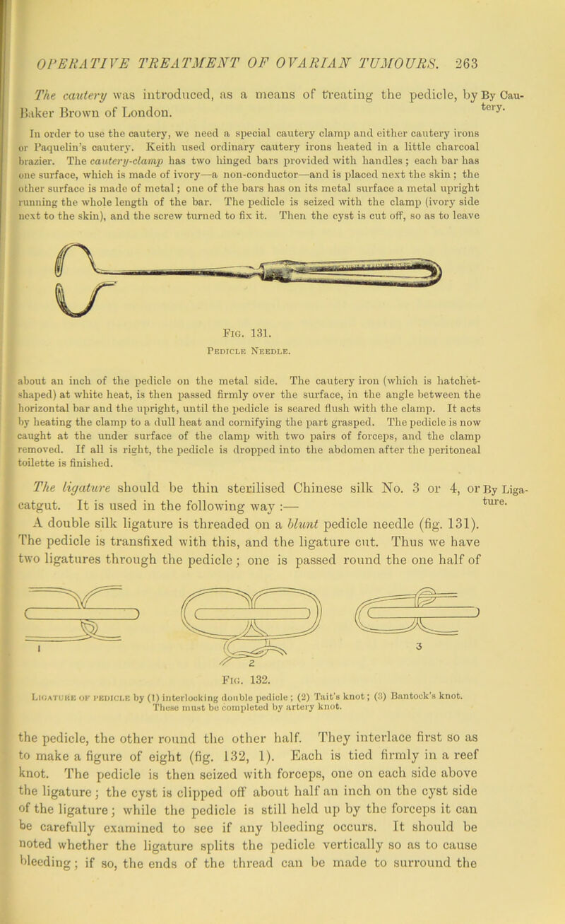 The cautery was inti’oduced, as a means of treating the pedicle, by By Cau- Baker Brown of London. In order to use the cautery, we need a special cautery clamp and either cautery irons or Paquelin’s cautery. Keith used ordinary cautery irons heated in a little charcoal In-azier. The cautery-clamp has two hinged bars provided with handles ; each bar has one surface, whicii is made of ivory—a non-conductor—and is placed next the skin ; the other surface is made of metal; one of the bars has on its metal surface a metal upright running the whole length of the bar. Tlie pedicle is seized with the clamp (ivory side next to the skin), and the screw turned to fix it. Then the cyst is cut off, so as to leave Fig. 131. Pedicle Needle. about an inch of the pedicle on the metal side. The cautery iron (which is hatchet- shaped) at white heat, is then passed firmly over the sm'face, in the angle between the horizontal bar and the upright, until the iiedicle is seared flush with the clamp. It acts by heating the clamp to a dull heat and cornifying the part grasped. The pedicle is now caught at the under surface of the clamp with two pairs of forceps, and the clamp removed. If all is right, the pedicle is dropped into the abdomen after the peritoneal toilette is finished. The ligature should be thin sterilised Chinese silk No. 3 or 4, orByLiga- catgut. It is used in the following way :— A double silk ligature is threaded on a blunt pedicle needle (fig. 131). The pedicle is transfixed with this, and the ligature cut. Thus we have two ligatures through the pedicle; one is passed round the one half of Fig. 132. Ligature ok pedicle by (1) interlocking double pedicle ; (2) Tait’s knot; (3) Bantock’s knot. Theae iniiat be completed by artery knot. the pedicle, the other round the other half. They interlace first so as to make a figure of eight (fig. 132, 1). Each is tied firmly in a reef knot. The pedicle is then seized with forceps, one on each side above the ligature; the cyst is clipped olT about half an inch on the cyst side of the ligature; while the pedicle is still held up by the forceps it can be carefully examined to see if any bleeding occurs. It should be noted whether the ligature splits the pedicle vertically so as to cause bleeding; if so, the ends of the thread can be made to surround the