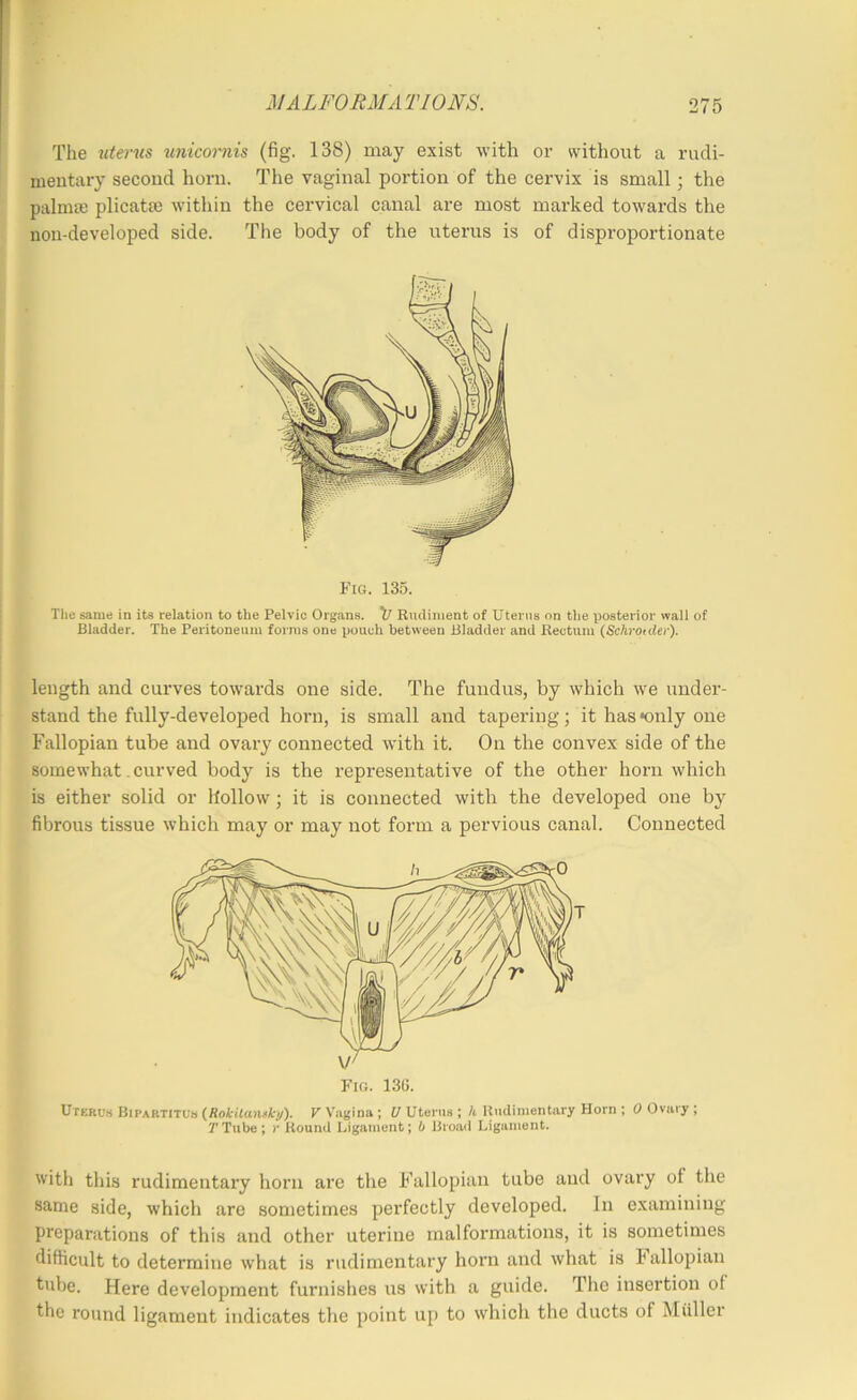 The uterus unicoi'iiis (fig. 138) may exist with or without a rudi- meutary second horn. The vaginal portion of the cervix is small; the palma) plicatce within the cervical canal are most marked towards the non-developed side. The body of the uterus is of disproportionate Fig. 135. The same in its relation to the Pelvic Organs. V Rudiment of Uterus on the posterior wall of Bladder. The Peritoneum foims one pouch between Bladder and Rectum (Schroider). length and curves towards one side. The fundus, by which we under- stand the fully-developed horn, is small and tapei’ing; it has ^only one Fallopian tube and ovary connected with it. On the convex side of the somewhat .curved body is the representative of the other horn which is either solid or hollow; it is connected with the developed one by fibrous tissue which may or may not form a pervious canal. Connected Uterus BiPARTiTUa (RotRaniil-y). P Vagina; Uterus; /t Ipidimentary Horn ; 0 Ovary ; 7’Tube; r Round Ligament; b Broad Ligament. with this rudimentary horn are the Fkillopian tube and ovary of the same side, which arc sometimes perfectly developed. In examining preparations of this and other uterine malformations, it is sometimes difficult to determine what is rudimentary horn and what is Fallopian tube. Here development furnishes us with a guide. The insertion of the round ligament indicates the point up to which the ducts of Muller