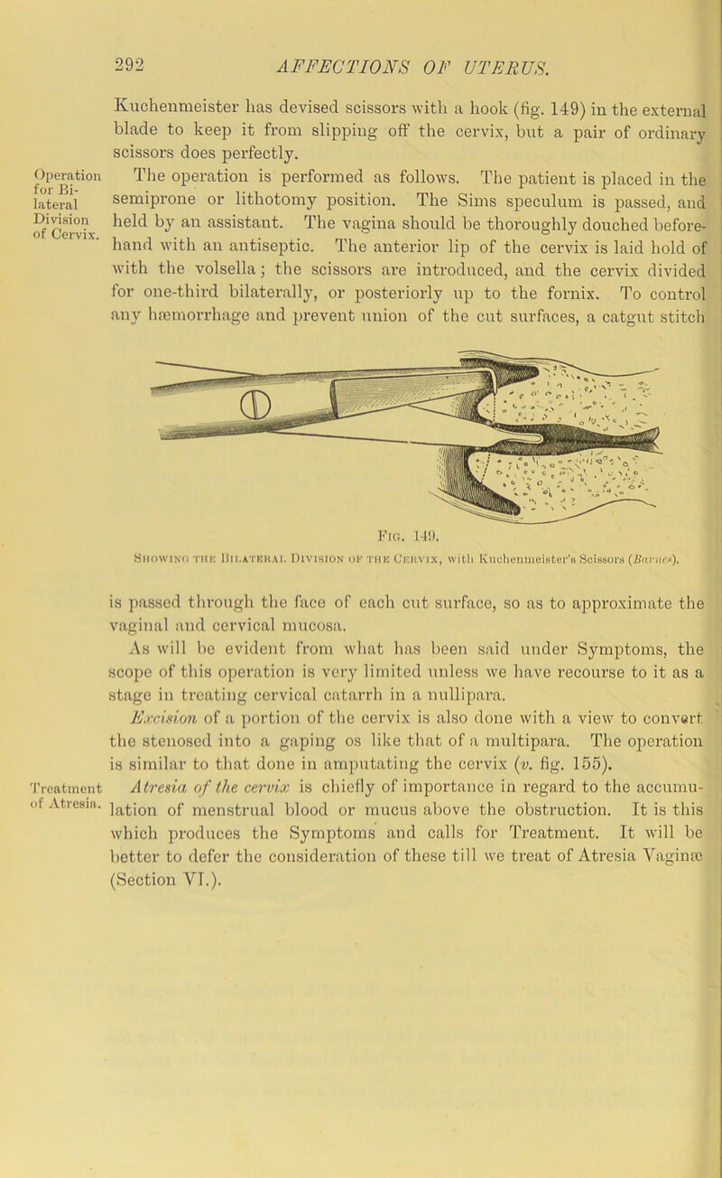 Operation for Bi- lateral Division of Cervix. 'I'reatinent of Atresia. Kuchenmeister has devised scissors with a hook (fig. 149) in the external blade to keep it from slipping off the cervix, but a pair of ordinary scissors does perfectly. The operation is performed as follows. The patient is placed in the semiprone or lithotomy position. The Sims speculum is passed, and ' held by air assistant. The vagina should be thoroughly douched before-' hand with an antiseptic. The anterior lip of the cervix is laid hold of. with the volsella j the scissors are introduced, and the cervix divided | for one-third bilaterally, or posteriorly up to the fornix. To control i any liannorrhage and prevent union of the cut surfaces, a catgut stitcli ! Fig. 14!). Hiiowixd TiiK Hii.ATEKAi. DIVISION OK Tiiu Ckiivi.x, witli Kuclicnmeister’8 Scissors (ilanip.i). is passed through tlie face of each cut surface, so as to approximate the vaginal and cervical mucosa. As will be evident from what has been said under Symptoms, the scope of tliis operation is very limited unless we liave recourse to it as a stage in treating cervical catarrh in a nullipara. E.vci.v',on of a portion of the cervix is also done with a view to convert the stenosed into a gaping os like that of a multipara. The operation is similar to tliat done in amputating the cervix (v. fig. 155). Atresia of the cervix is chiefly of importance in regard to the accumu- lation of menstrual blood or mucus above the obstruction. It is this which produces tlie Symptoms and calls for Treatment. It will be better to defer the consideration of these till we ti’eat of Atresia Vaginre (Section VI.).