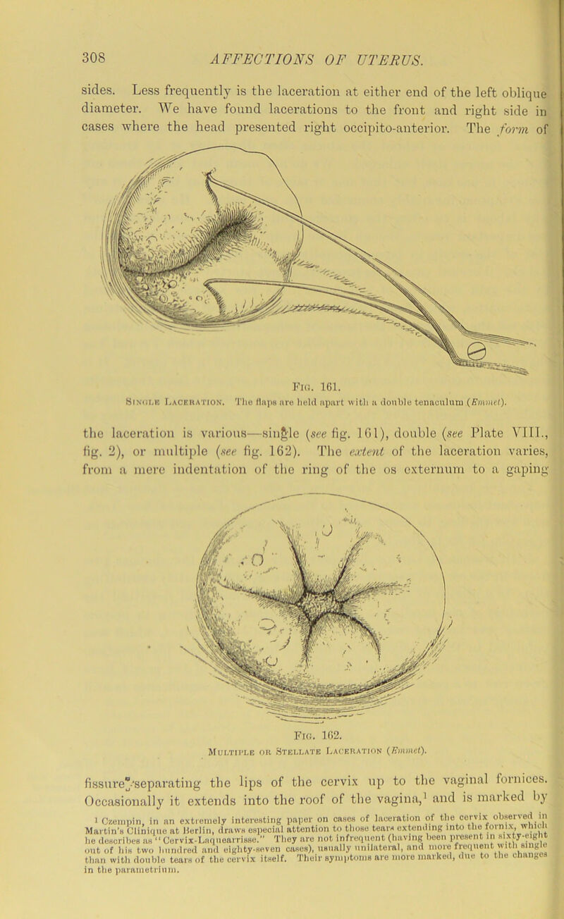 sides. Less frequently is tlie laceration at either end of the left oblique diameter. We have found lacerations to the front and right side in cases where the head presented right occipito-anterior. The form of Fui. 161. SiNiii.K I.ACEiiATiON. Tlio flaps are held apart with a double tenaculum (Eiwncl). the laceration is various—sin/^le (see iig. 101), double (see Plate VIII., fig. 2), or multiple (.see fig. 162). The e.vieni of the laceration varies, from a mere indentation of the ring of the os e.xternum to a gaping Fig. 162. Mui/ni’LE OR .Stellate Lackration (Emmet). fissure“'separating the lips of the cervi.x up to the vaginal fornices. Occasionally it extends into the roof of the vagina,^ and is marked bj 1 Czerapin, in an extiemely interesting paper on oases of laceration of the cervix Martin’s Clinique at Herliii, draws especial attention to those tears extending into the foi nix, wlnui he describes as “ Cervix-Laquearrisse.” They are not infrequent (having been present in sixty-eight out of his two hundred ami eighty-seven cases), usually unilateral, and niore frequent vutli single than with double tears of the cervix itself. Their symptonis are more marked, due to the changes in the parnmetriiini.