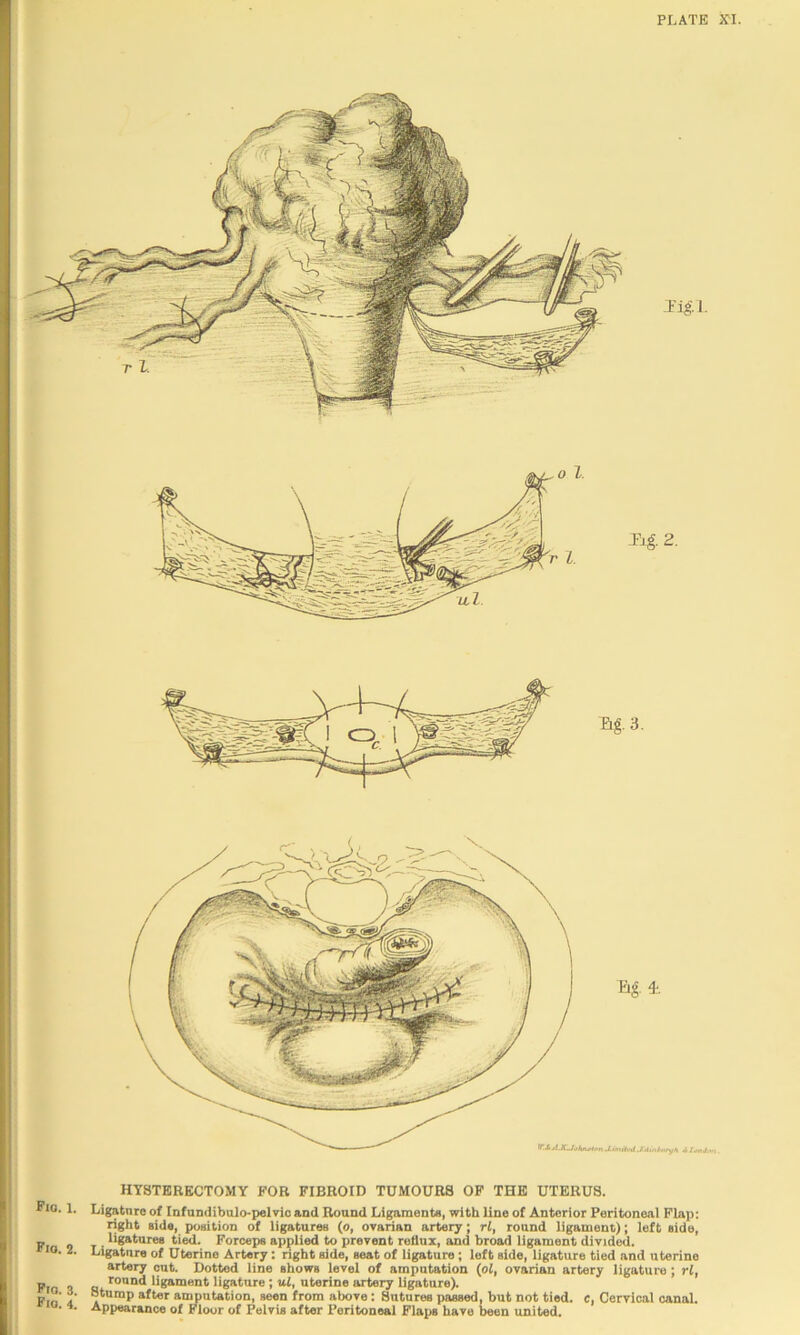 PLATE XT. 2. HYSTERECTOMY FOR FIBROID TUMOURS OF THE UTERUS. right side, poeition of ligatures (o, ovarian artery; rl, round ligament); left side, p . ligatures ti^. Forcepe applied to prevent reflux, and broad ligament divided. 10. 2. Ligatnre of Uterine Artery: right side, seat of ligature; loft side, ligature tied and uterine artery out. Dotted line shows level of amputation (oj, ovarian artery ligature; rl, Pm n n ligament ligatnre ; ul, uterine artery ligature). Pin s » aimintation, seen from above: Sutures passed, but not tied, c, Cervical canal. • Appearance of Floor of Polvia after Peritoneal Fla^>s have been united. Tig. 3. Tig T. Tlg.l.