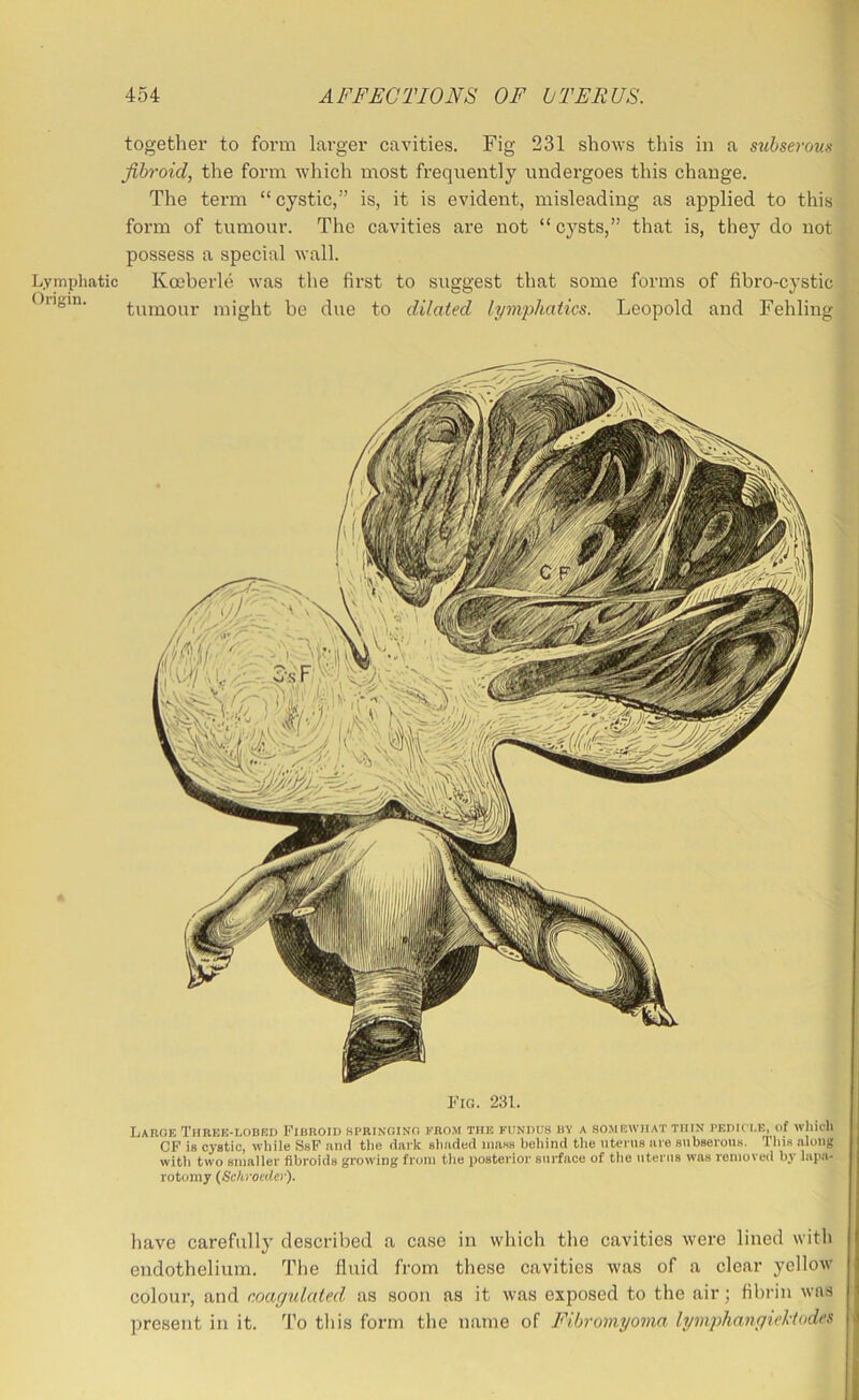 together to form larger cavities. Fig 231 shows this in a sM5se?'ow.s w fibroid, the form which most frequently undergoes this change. (r The term “cystic,” is, it is evident, misleading as applied to this*; form of tumour. The cavities are not “cysts,” that is, they do not*’ possess a special wall. |h Lyitipliatic Koeberle was the first to suggest that some forms of fibro-cystic’ljj Origin. tumour might be due to dilated lyrn'phatics. Leopold and Fehling'E Fig. 231. j Large Three-lobed Fibroid springing from the fundus by a somewhat thin pedici.e, of wliii-h n CF is cystic, wliile SsF iinii the dark shaded mass behind tiie uterus are subserous. Tliis along ^ witii two smaller fibroids growing from tlie posterior surface of tlie uterus was removed by lapa- rotomy (Schroeder). I liave carefully described a case in which the cavities were lined with ■ endothelium. The fluid from these cavities was of a clear yellow * colour, and coagulated as soon as it was exposed to the air; fibrin was i; present in it. To this form the name of Fibromyoma lymphangiehtodes (