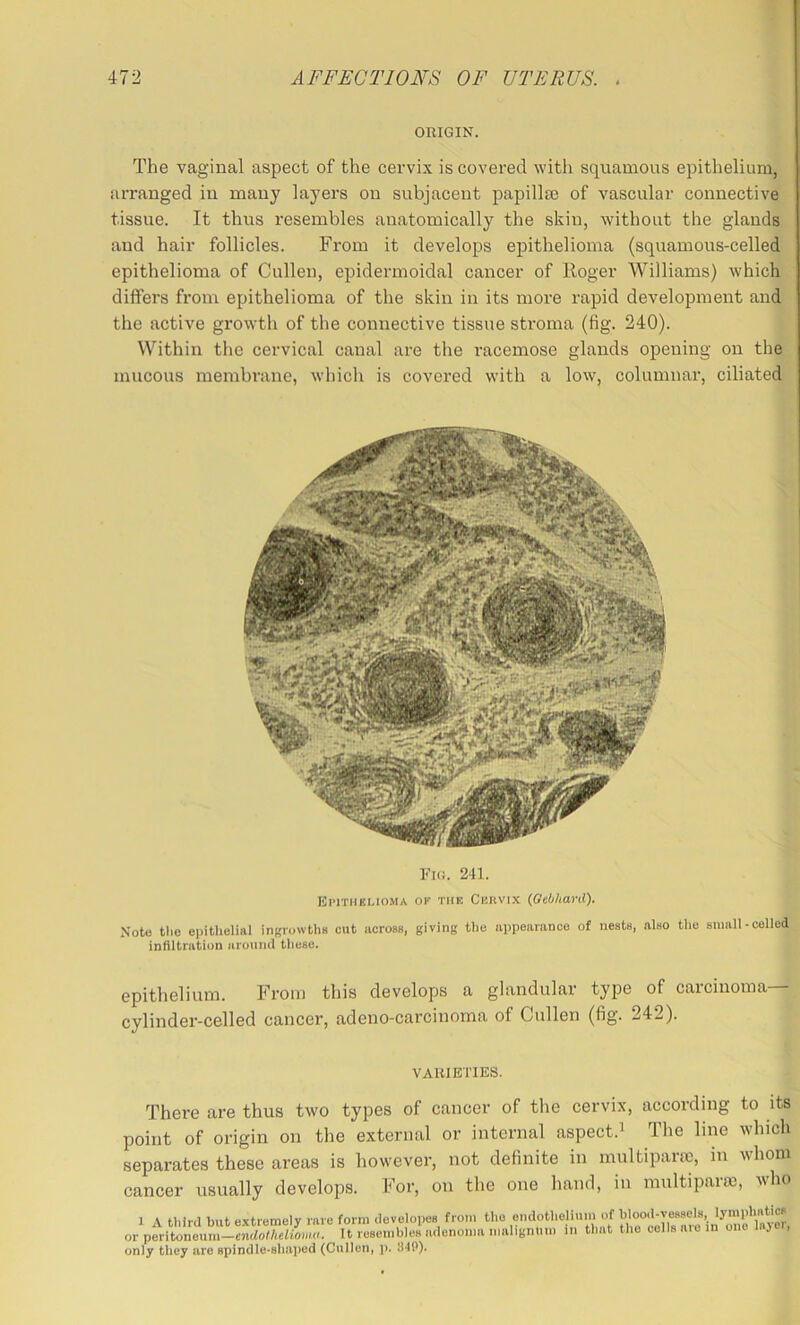 ORIGIN. The vaginal aspect of the cervix is covered with squamous epithelium, arranged in many layers on subjacent papillm of vascular connective tissue. It thus resembles anatomically the skin, without the glands and hair follicles. From it develops epithelioma (squamous-celled epithelioma of Cullen, epidermoidal cancer of Roger Williams) which differs from epithelioma of the skin in its more rapid development and the active growth of the connective tissue stroma (fig. 240). Within the cervical canal are tlie racemose glands opening on the mucous membrane, which is covered with a low, columnar, ciliated Note the e))ithelial ingrowths out across, giving the appearance of neats, also the small-celled infiltration around these. epithelium. From this develops a glandular type of carcinoma— cylinder-celled cancer, adeno-carcinoma of Cullen (fig. 242). There are thus two types of cancer of the cervix, according to its point of origin on the external or internal aspect.^ The line which separates these areas is however, not definite in multipanc, in whom cancer usually develops. For, on the one hand, in multipart, who Fi(i. 241. EiTniELioMA OK THE CERVIX (Gebhani). VARIETIES. 1 A third but extremely ra or peritoneum—endothelionw only they are spindle-shaped (Cullen, p. SIP).