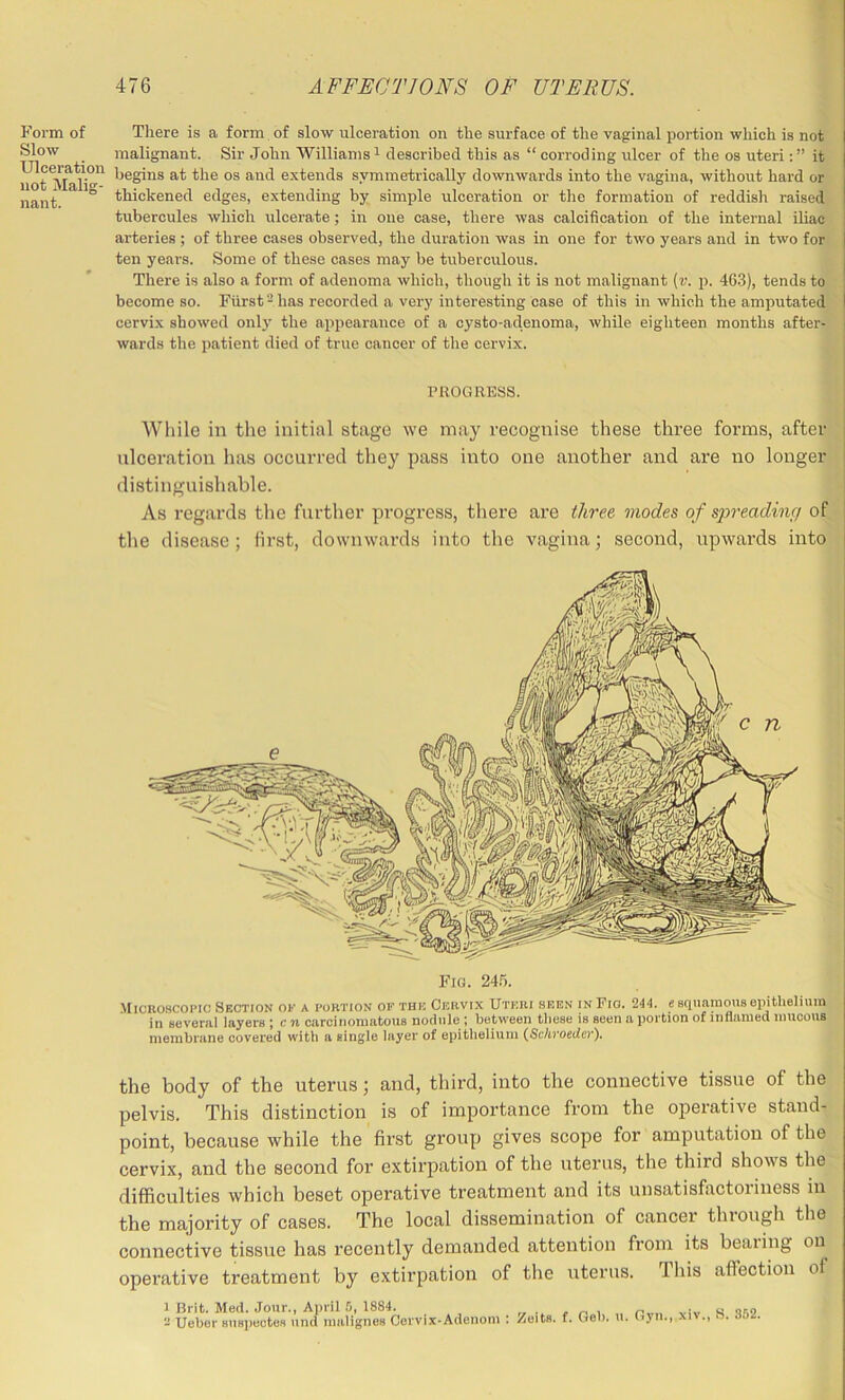 Form of Slow Ulceration not Malig- nant. There is a form of slow ulceration on the surface of the vaginal portion which is not malignant. Sir John Williams ^ described this as “ corroding nicer of the os uteri: ” it ijegins at the os and extends symmetrically downwards into the vagina, without hard or thickened edges, extending by simple ulceration or the formation of reddish raised tubercules which ulcerate; in one case, there was calcification of the internal iliac arteries ; of three cases observed, the duration was in one for two years and in two for ten years. Some of these cases may be tuberculous. j There is also a form of adenoma which, though it is not malignant [v. p. 463), tends to i become so. Furst-has recorded a very interesting case of this in which the amputated I cervix showed only the appearance of a cysto-adenoma, while eighteen months after- i wards the patient died of true cancer of the cervix. PROGRESS. 41: While in the initial stage we may recognise these three forms, aftei’ ulceration has occurred they pass into one another and are no longer : distinguishable. As regards the further Y)rogress, there are three modes of spreading of 1 the disease; first, downwards into the vagina; second, upwards into i Fig. 24.5. Micnoscoric Section ok a portion of the Cervix Uteri seen in Fig. 244. e scinaraoiis epithelium in several layers ; c n carcinomatous nodule ; between these is seen a portion of inflamed mucous membrane covered with a single layer of epithelium {Sckvoeder). the body of the uterus; and, third, into the connective tissue of the pelvis. This distinction is of importance from the operative stand- point, because while the first group gives scope for amputation of the cervix, and the second for extirpation of the uterus, the third shows the difficulties which beset operative treatment and its unsatisfactoiiness in the majority of cases. The local dissemination of cancer through the connective tissue has recently demanded attention from its bearing on operative treatment by extirpation of the uterus. This affection of 1 Brit. Med. Jour., April 5, 1884. - Ueber sueiieotee und malignes Cervix-Adonom ZoitB. f. Gel), u. Gyn., xiv., S. 352.