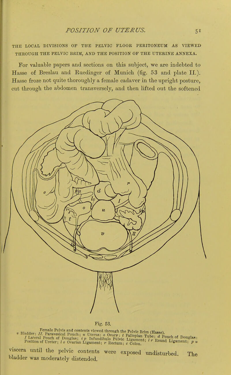 THE LOCAL DIVISIONS OF THE PELVIC FLOOR PERITONEUM AS VIEWED THROUGH THE PELVIC BRIM, AND THE POSITION OF THE UTERINE ANNEXA. For valuable papers and sections on this subject, we are indebted to Hasse of Breslau and Ruedinger of Munich (fig. 53 and plate II.). Hasse froze not quite thoroughly a female cadaver in the upright posture, cut through the abdomen transversely, and then lifted out the softened \ Fig. 53. RWuw rr T - T1 c?ntentf,viewed through the Pelvic Brim (Hasse) Bladder; // Paravesical Pouch; u Uterus; o Ovnry; t Fallopian Tube- , L.i, , / Lateral Pouch of Douglas; ip Infundibulo Pelvic LigamentI , D°nRl*»: Position of Ureter; lo Ovarian Ligament; r Uectum T Colon ' Ligament; pa viscera until the pelvic contents were exposed undisturbed, bladder was moderately distended. The