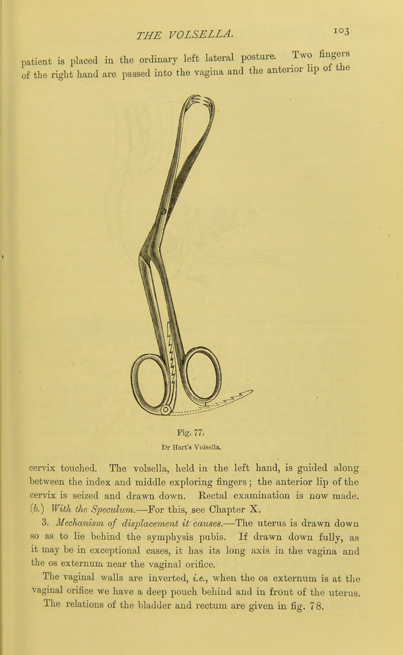 patient is placed in the ordinary left lateral posture. Two fingers of the right hand are passed into the vagina and the anterior hp of tne Fig. 77. Dr Hart's Volsella, cervix touched. The volsella, held in the left hand, is guided along between the index and middle exploring fingers; the anterior lip of the cervix is seized and drawn down. Rectal examination is now made. (b.) With the Speculum.—For this, see Chapter X. 3. Meclianism of displacement it causes.—The uterus is drawn down so as to lie behind the symphysis pubis. If drawn down fully, as it may be in exceptional cases, it has its long axis in the vagina and the os externum near the vaginal orifice. The vaginal walls are inverted, i.e., when the os externum is at the vaginal orifice we have a deep pouch behind and in front of the. uterus. The relations of the bladder and rectum are given in fig. 78.