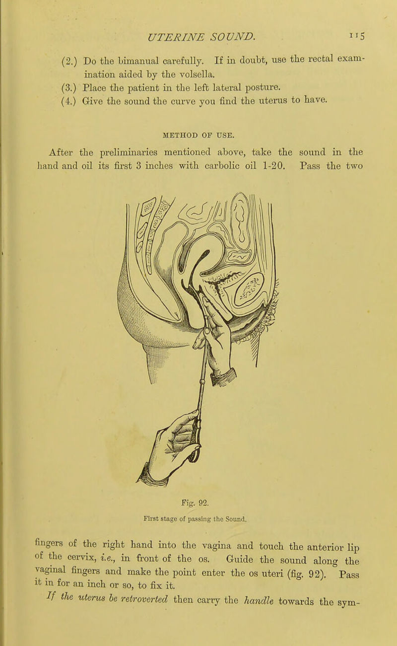 (2.) Do the bimanual carefully. If in doubt, use the rectal exam- ination aided by the volsella. (3.) Place the patient in the left lateral posture. (4.) Give the sound the curve you find the uterus to have. METHOD OF USE. After the preliminaries mentioned above, take the sound in the hand and oil its first 3 inches with carbolic oil 1-20. Pass the two Fig. 92. First stage of passing the Sound. fingers of the right hand into the vagina and touch the anterior lip of the cervix, i.e., in front of the os. Guide the sound along the vaginal fingers and make the point enter the os uteri (fig. 92). Pass it in for an inch or so, to fix it. If the uterus be retroverted then carry the handle towards the sym-