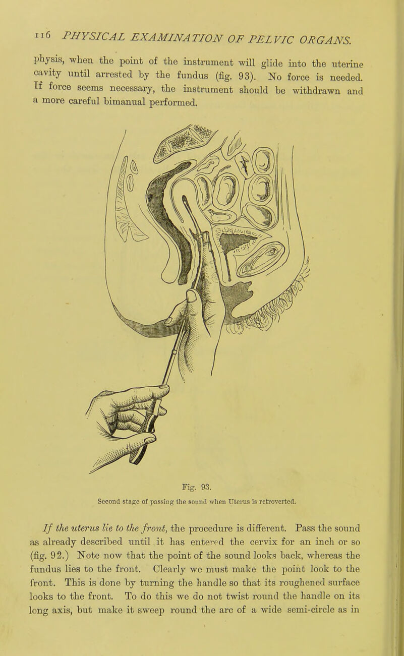 physis, when the point of the instrument will glide into the uterine cavity until arrested by the fundus (fig. 93). No force is needed. If force seems necessary, the instrument should be withdrawn and a more careful bimanual performed. Fig. 93. Second stage of passing the sound when Uterus is retrovertcd. If the uterus lie to the front, the procedure is different. Pass the sound as already described until it has entered the cervix for an inch or so (fig. 92.) Note now that the point of the sound looks back, whereas the fundus lies to the front. Clearly we must make the point look to the front. This is done by turning the handle so that its roughened surface looks to the front. To do this we do not twist round the handle on its long axis, but make it sweep round the arc of a wide semi-circle as in